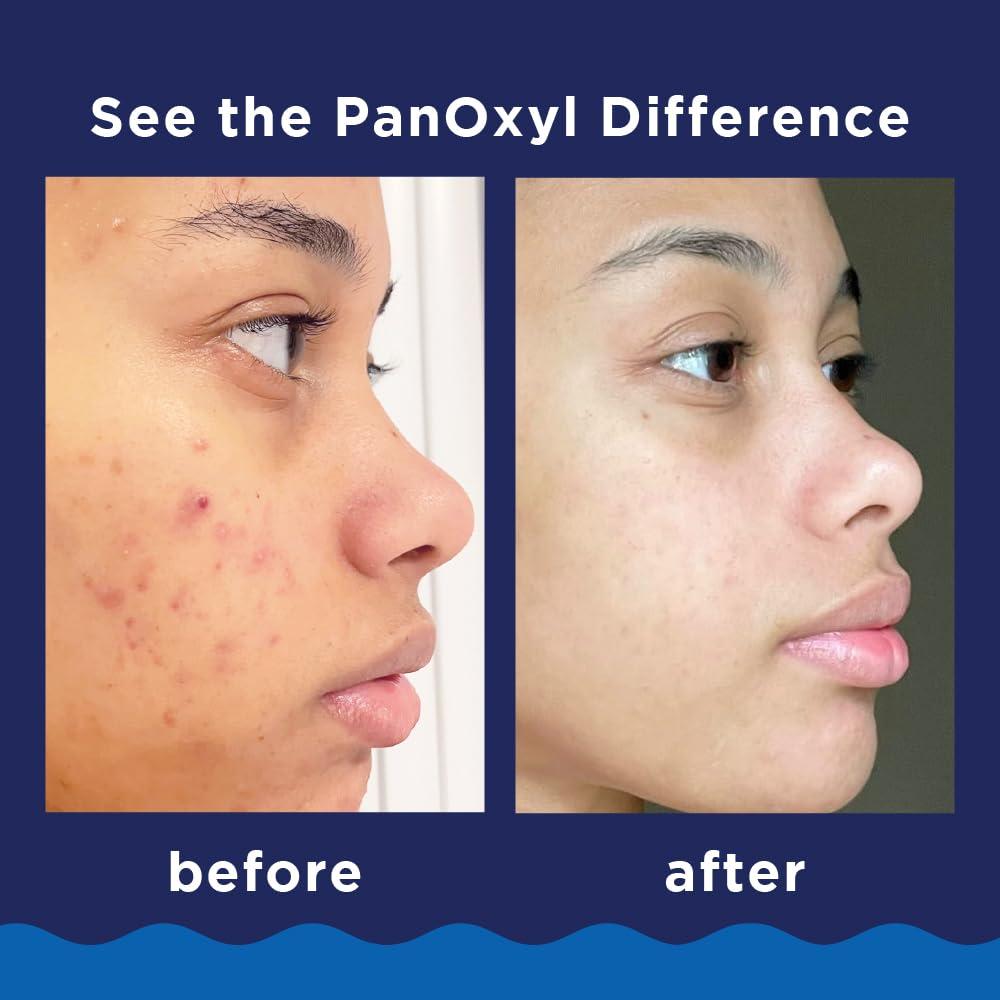 PanOxyl PanOxyl Acne Foaming Wash Benzoyl Peroxide 10% Maximum Strength Antimicrobial, 5.5 Oz (Pack of 2)