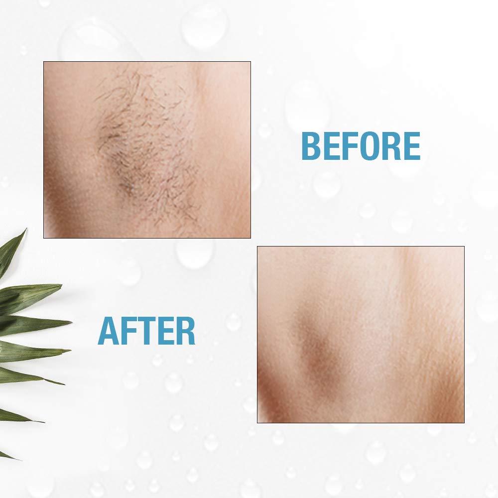 Clean + Easy Clean + Easy Electrolysis Machine for Permanent Hair Removal - Non-Laser, Painless Electrolysis Hair Removal for Face & Body, At-Home Remover Device