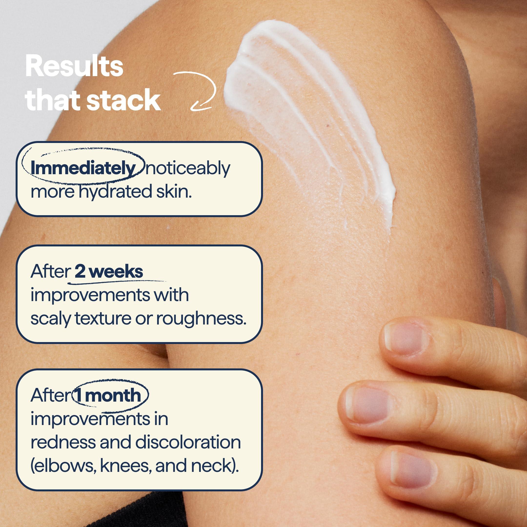 Remedy Science Remedy for Body Bumps Treatment for Keratosis Pilaris (KP) and Textured, Crepey Skin with Urea, Lactic Acid, and Retinol - Smoothing Body Moisturizer Lotion By Dermatologist Dr. Shah