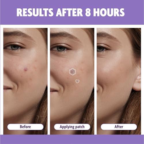 FreeGo Deep Blemish Microdarts | Pimple Patch | Cystic Acne | Fast-Acting | Quick Calming | 99.9% Pure Magnesium | Madecassic Acid | Tea Tree | Eucalyptus Leaf | Hydrocolloid Spot Care