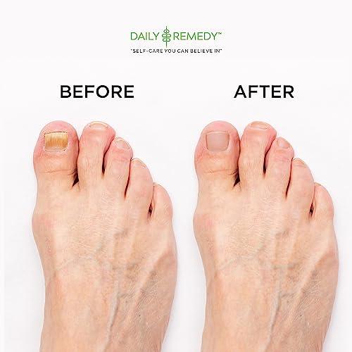 DAILY REMEDY EXTRA STRENGTH Tea Tree Oil Foot Soak with Epsom Salt - Made in USA - for Toenails, Athlete\'s Foot, Itchy Feet, Stubborn Smelly Foot Odor, Pedicure, Foot Calluses & Soothes Sore Tired Achy Feet -16 oz