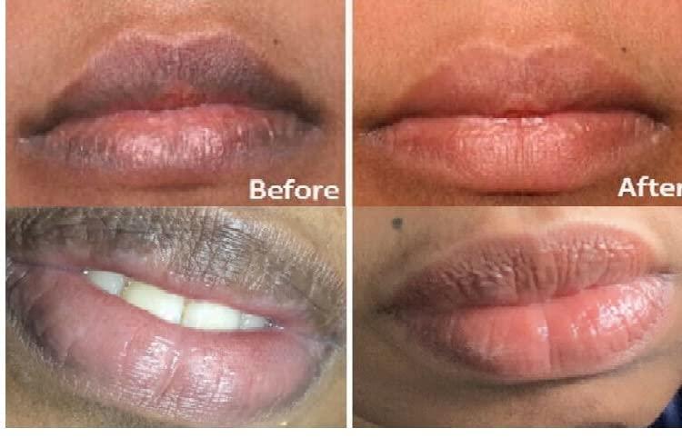 ZWSP 2pcs Real Lips Pink Fresh Lightening Bleaching Cream Treatment Remove Dark Smoke Lips lip oil