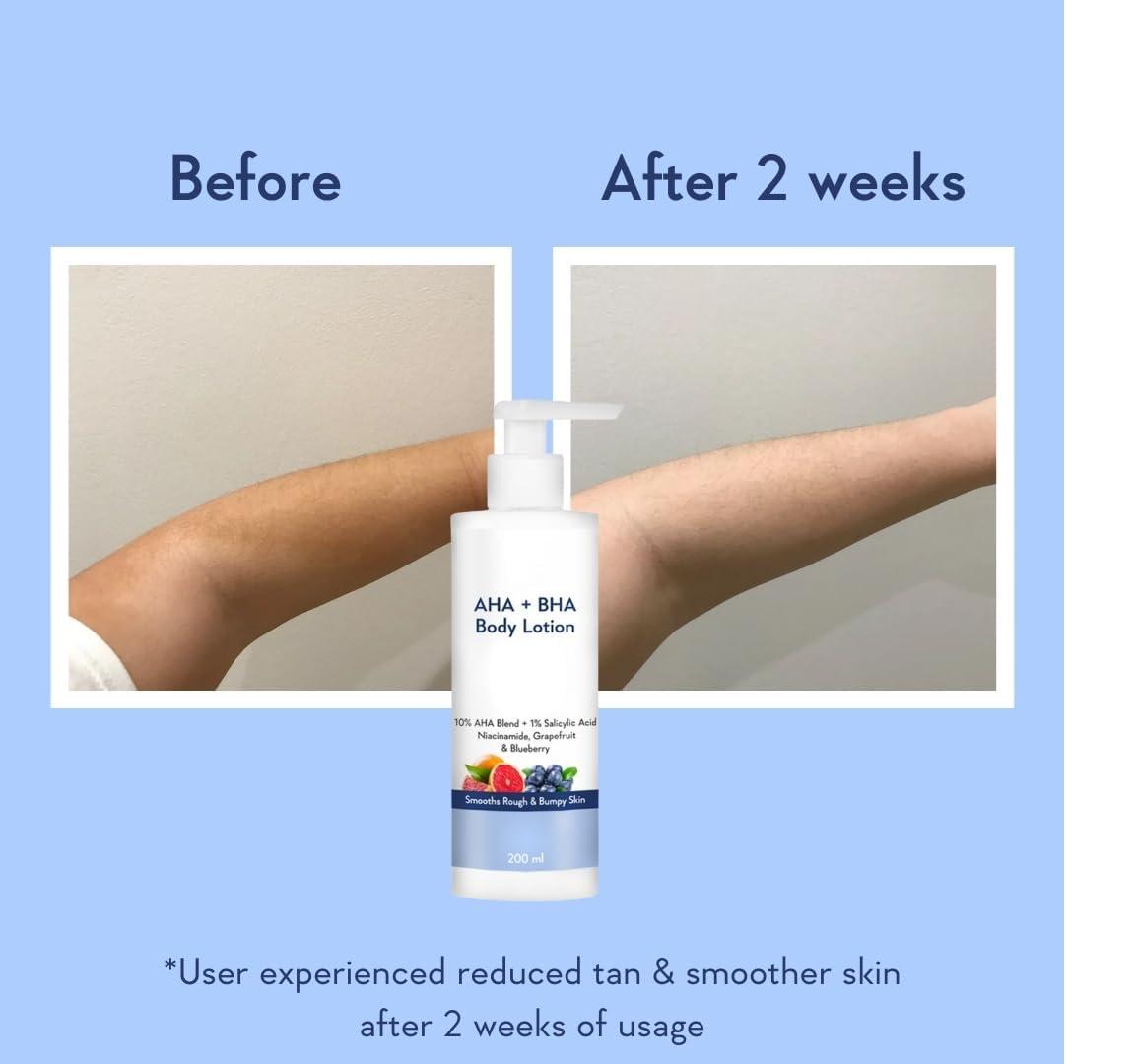 Generic JAY 10% AHA + 1% BHA Body Lotion - Smooths Rough & Bumpy Skin - Glycolic & Lactic Acid Body Lotion with Niacinamide - 200 Ml