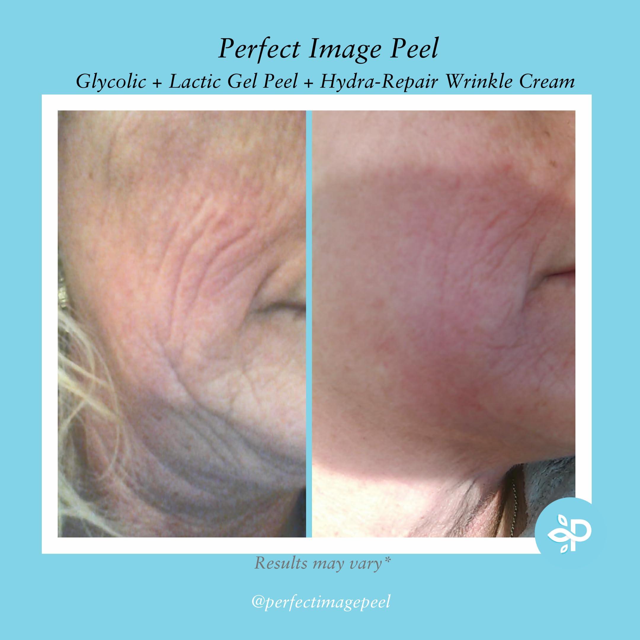 Perfect Image Glycolic Gel Peel - Enhanced with Retinol and Green Tea Extract (10% Strength)