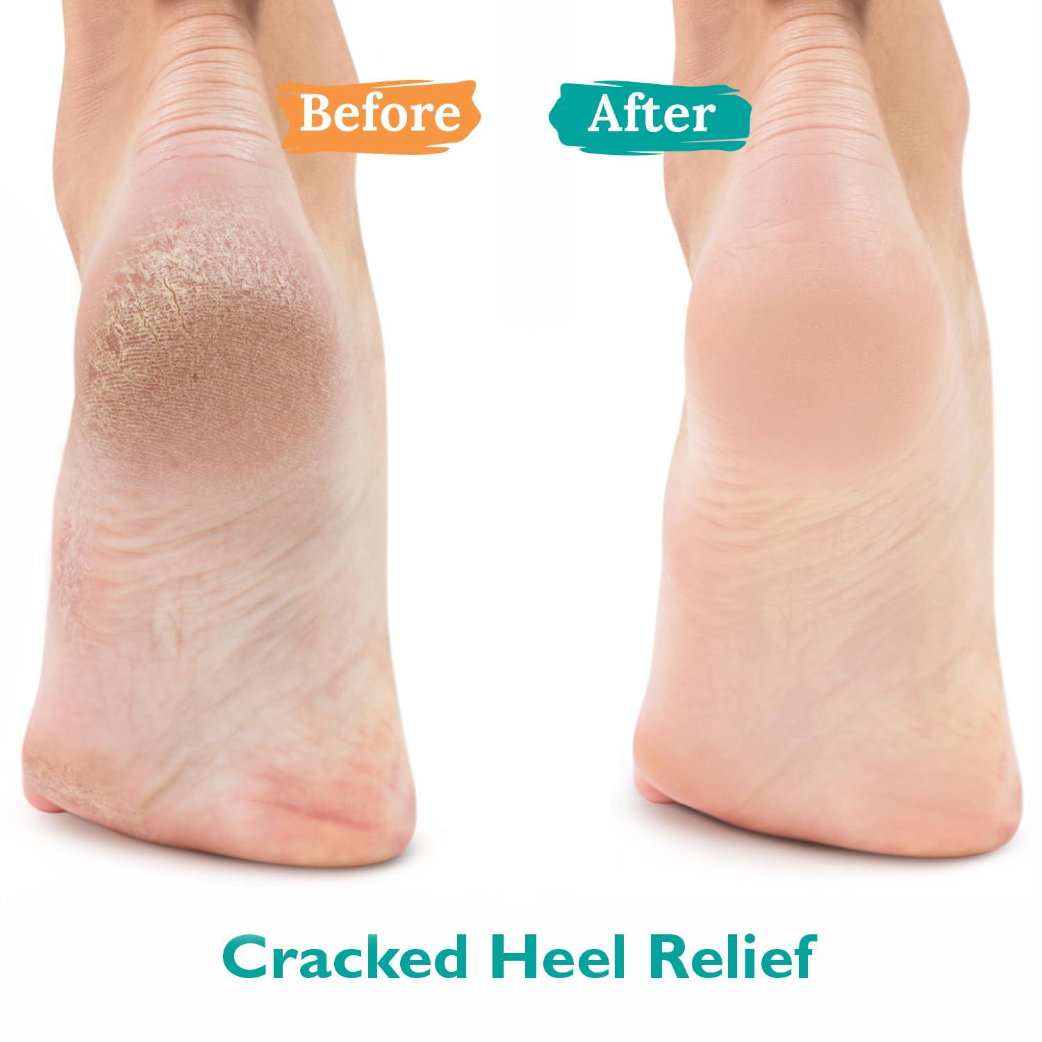 GILDEN TREE GILDEN TREE Urea Gel 42 Percent For Feet Maximum Strength Softens Cracked Heel Calluses & Thick Toenails