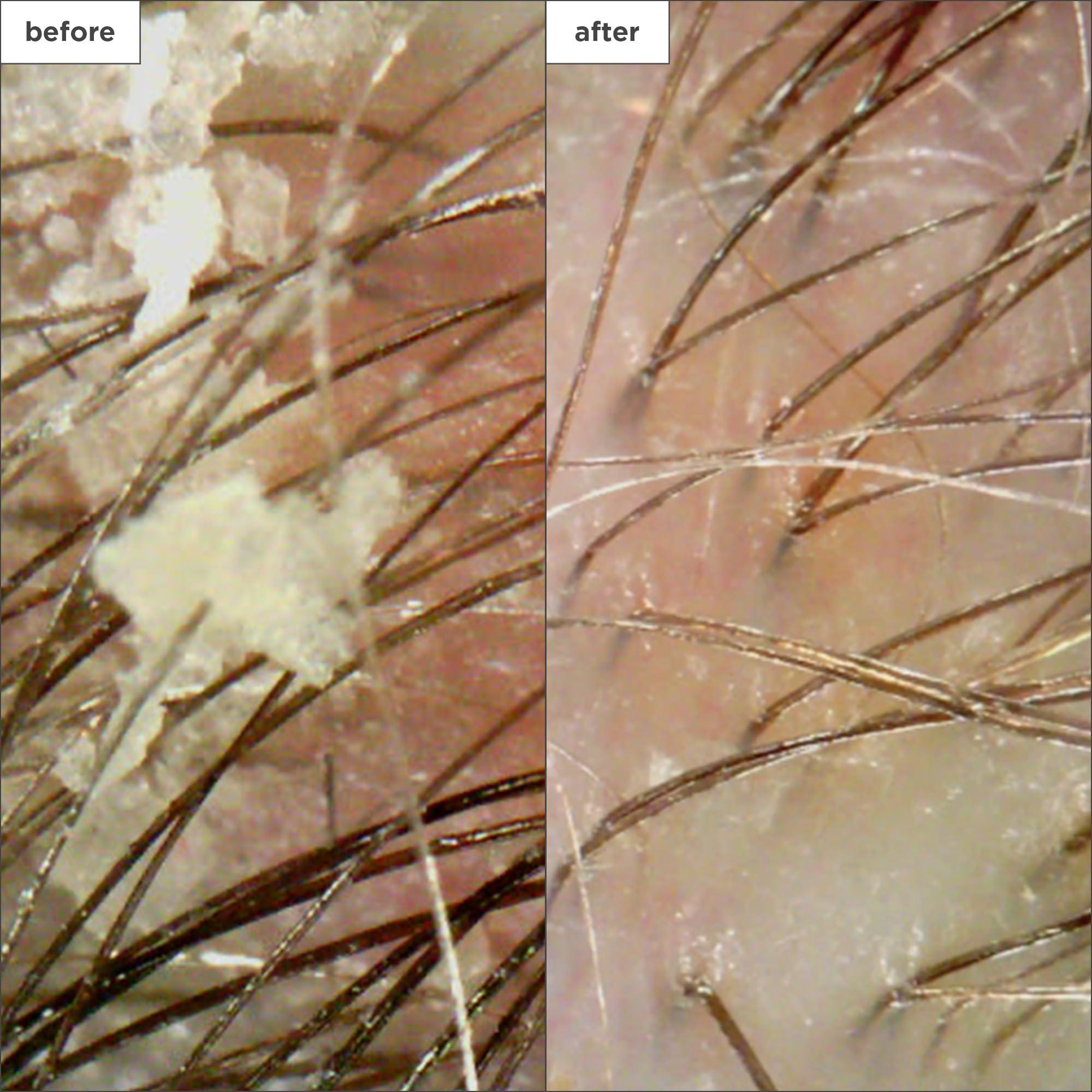 Briogeo Briogeo Scalp Revival Charcoal + Coconut Oil Micro-Exfoliating Shampoo, Treatment for Dry & Itchy Scalp, Clarifying Shampoo for Build Up, Scalp Scrub for Oily Scalp, Vegan, Cruelty-Free, 8 fl oz