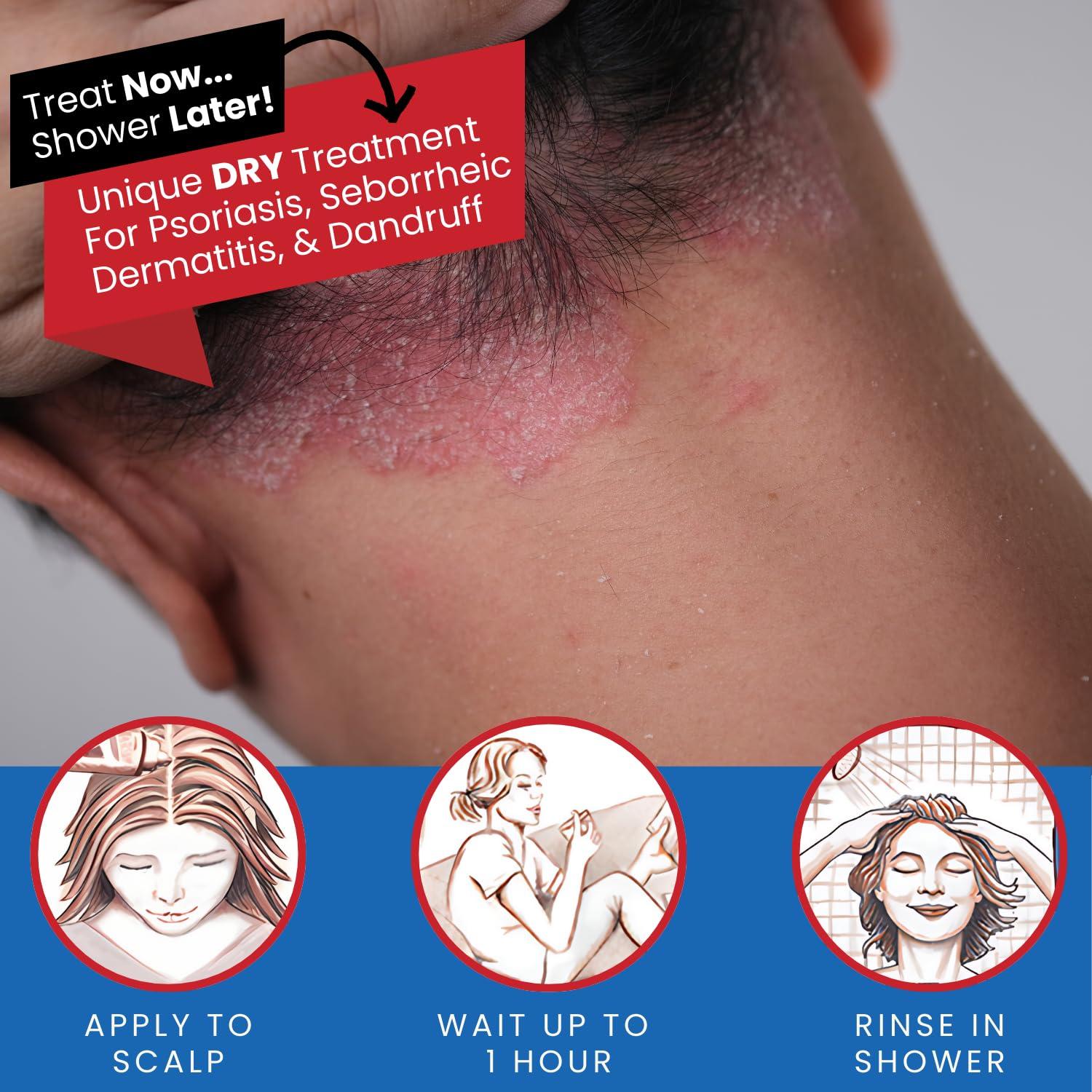 Tarsum Tarsum Extra Strength Psoriasis Shampoo - Coal Tar Shampoo and Conditioner for Scalp Psoriasis, Seborrheic Dermatitis, Severe Dandruff, & Eczema - Exfoliating Relief for Flaky, & Itchy Scalp (4 oz)