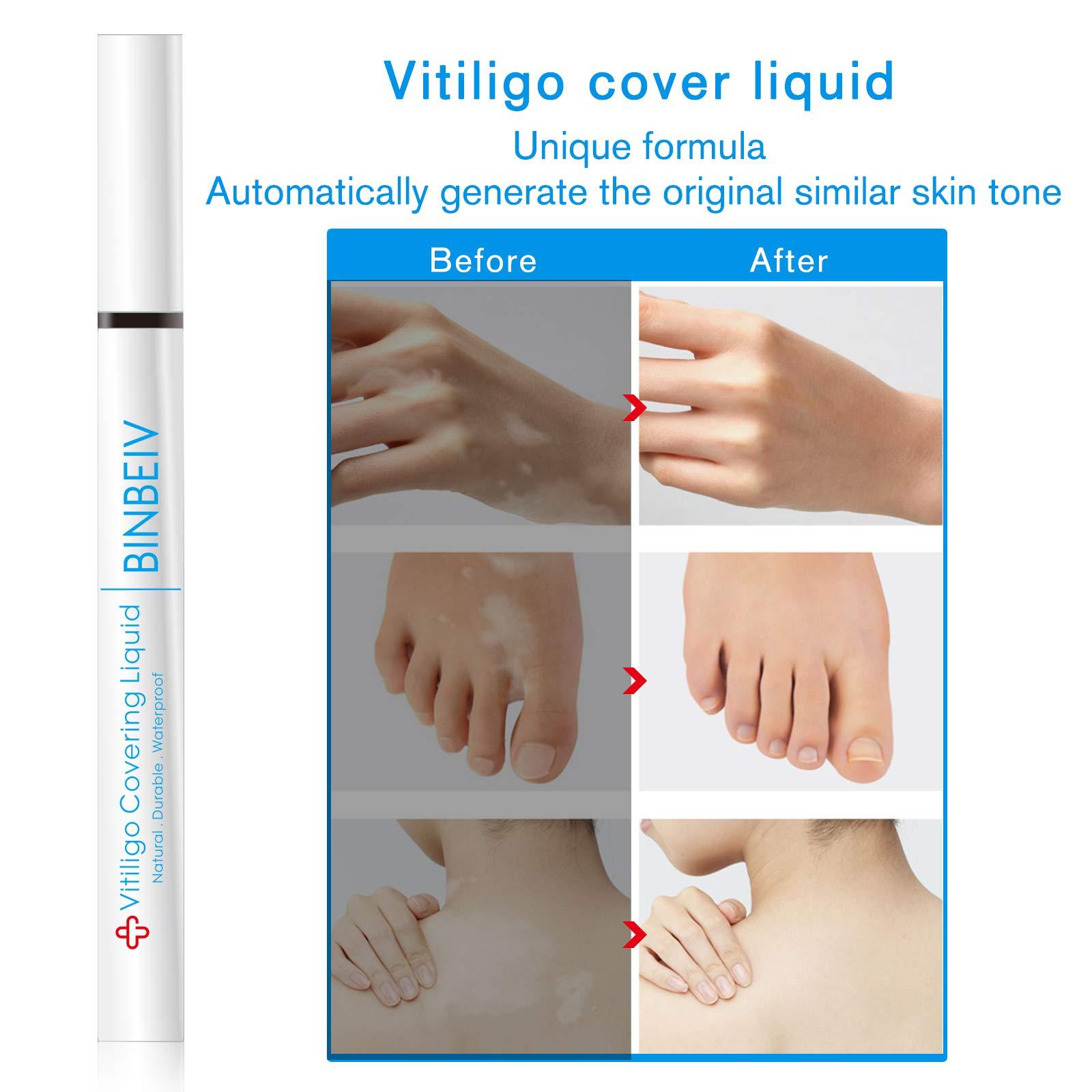 BINBEIV BINBEIV Vitiligo Cosmetic Camouflage Liqui, Cover appearance of Skin Depigmentation, Natural-Durable-Waterproof, Makeup Cover Waterproof, Used on face, hands and body