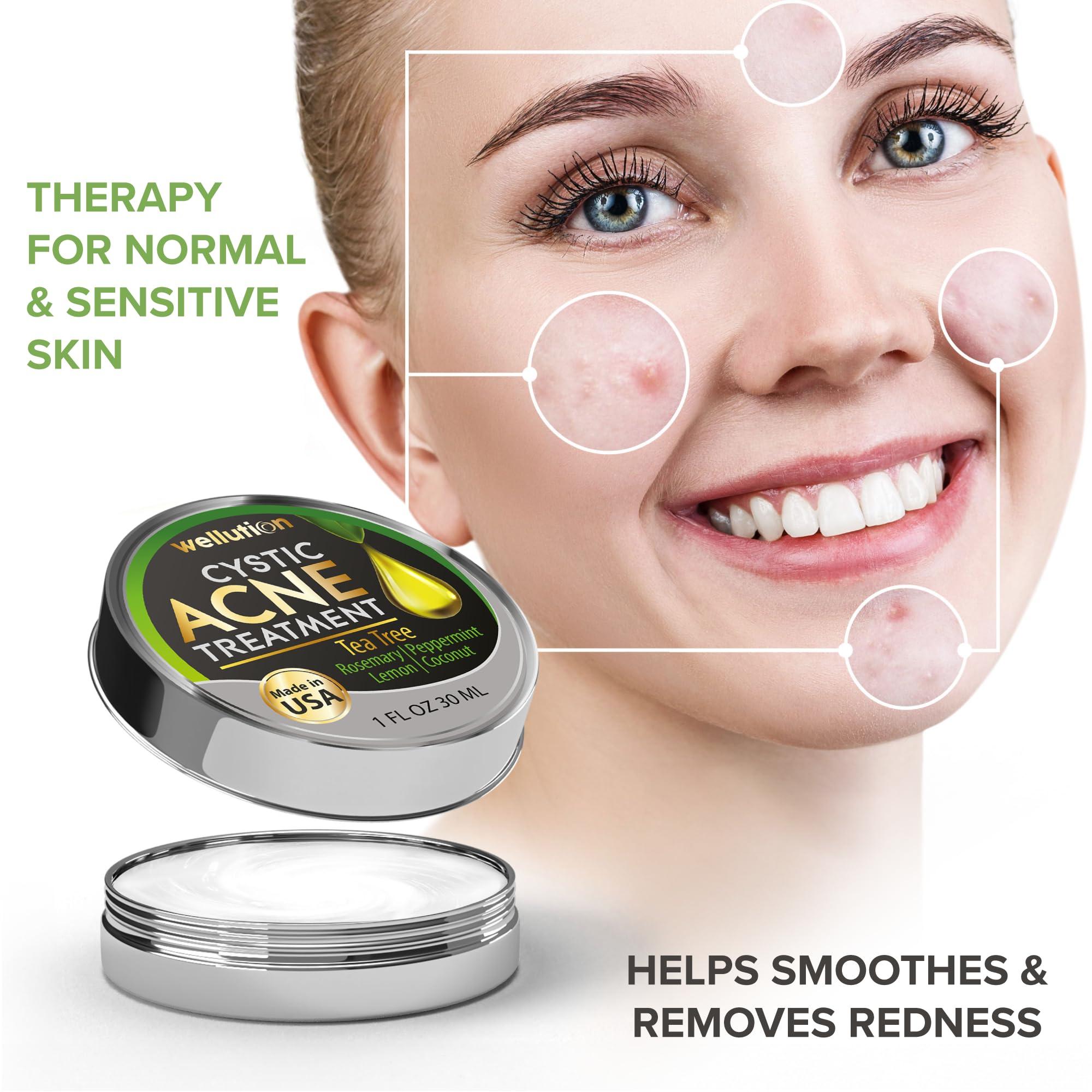 WELLUTION Wellution Cystic Acne Treatment Cream - Natural Pimple and Scar Remover with Tea Tree Oil - Effective Overnight Face Treatment for Acne Spots, Pimples and Scars - 1oz