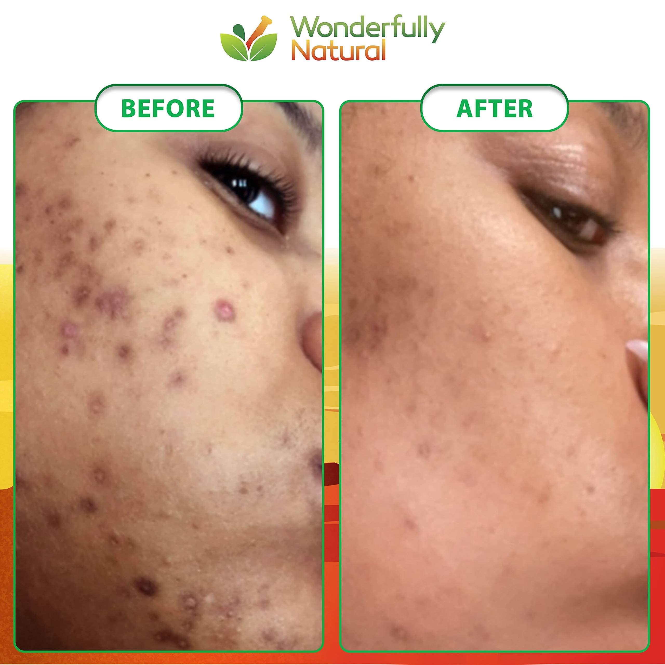 Wonderfully Natural Organic African Black Soap - For Acne & Dark Spots | Natural Vegan and Cruelty Free Satisfaction Guarantee 1lb bar | 90 day Supply