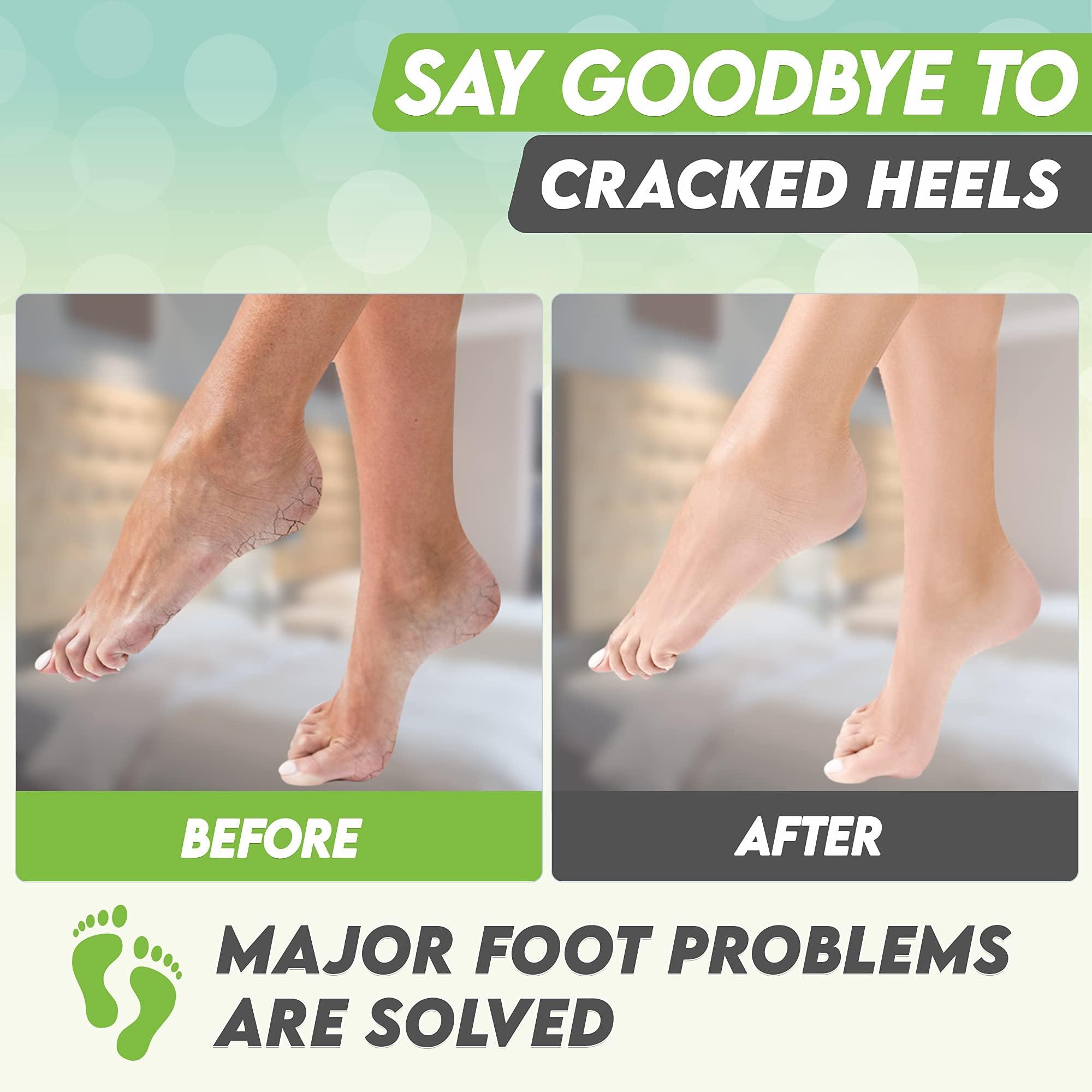 karma organic Foot Peel Mask Green Tea Moisturizing Exfoliating Foot Masks - Karma Organic Feet Peeling Masks for Dry ed Feet, Remove Dead Skin & Calluses - Removes & Repairs Rough Heels, Dry Toe Skin (Pack of 2)