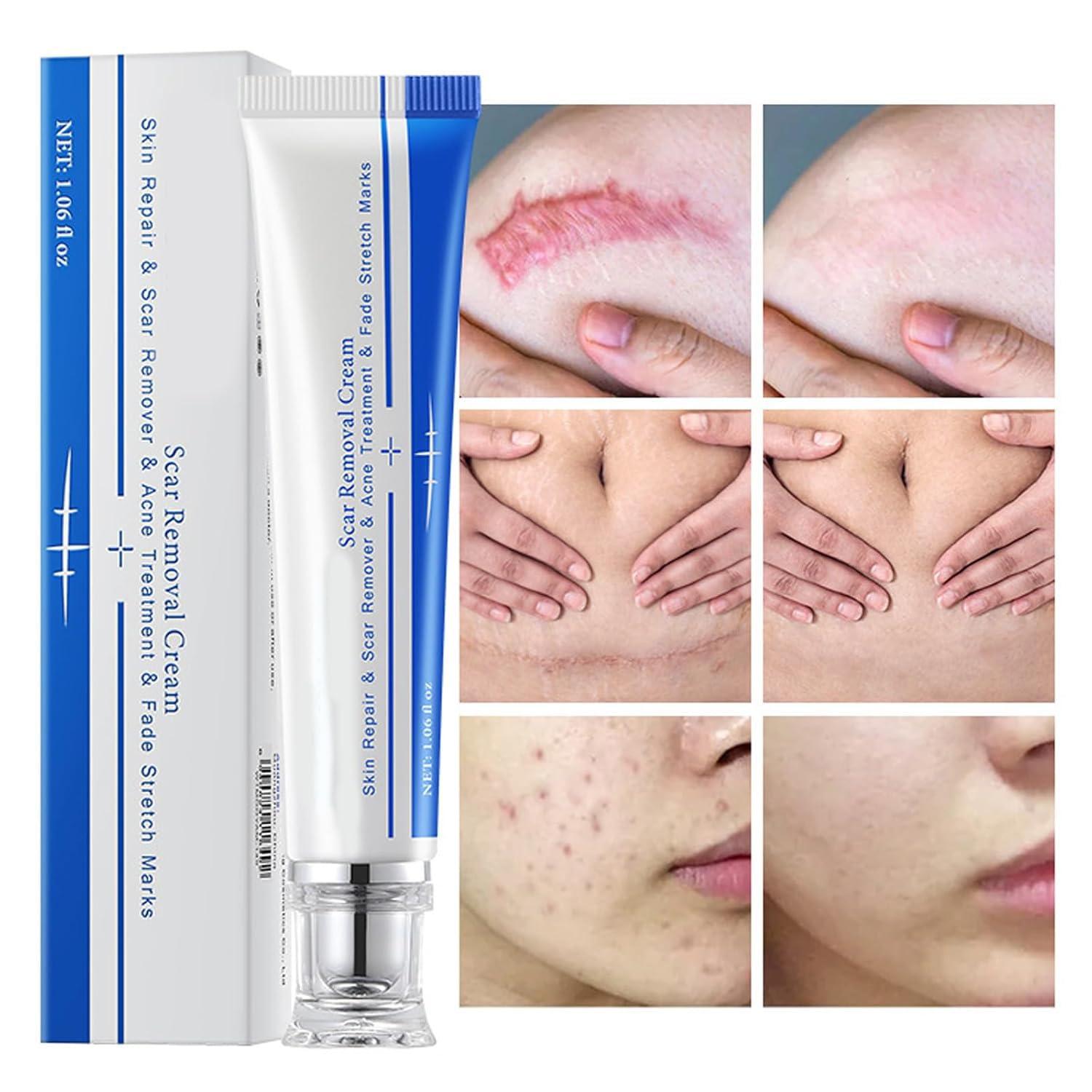 Generic Advanced Scar Cream Gel, Scar Removal Cream for Skin Face Body, Medical-Grade Silicone Gel Treatments for Keloid C-Section Acne Surgical Burns Stretch Marks - Old and New Scars 1.0 oz (1 PCS)