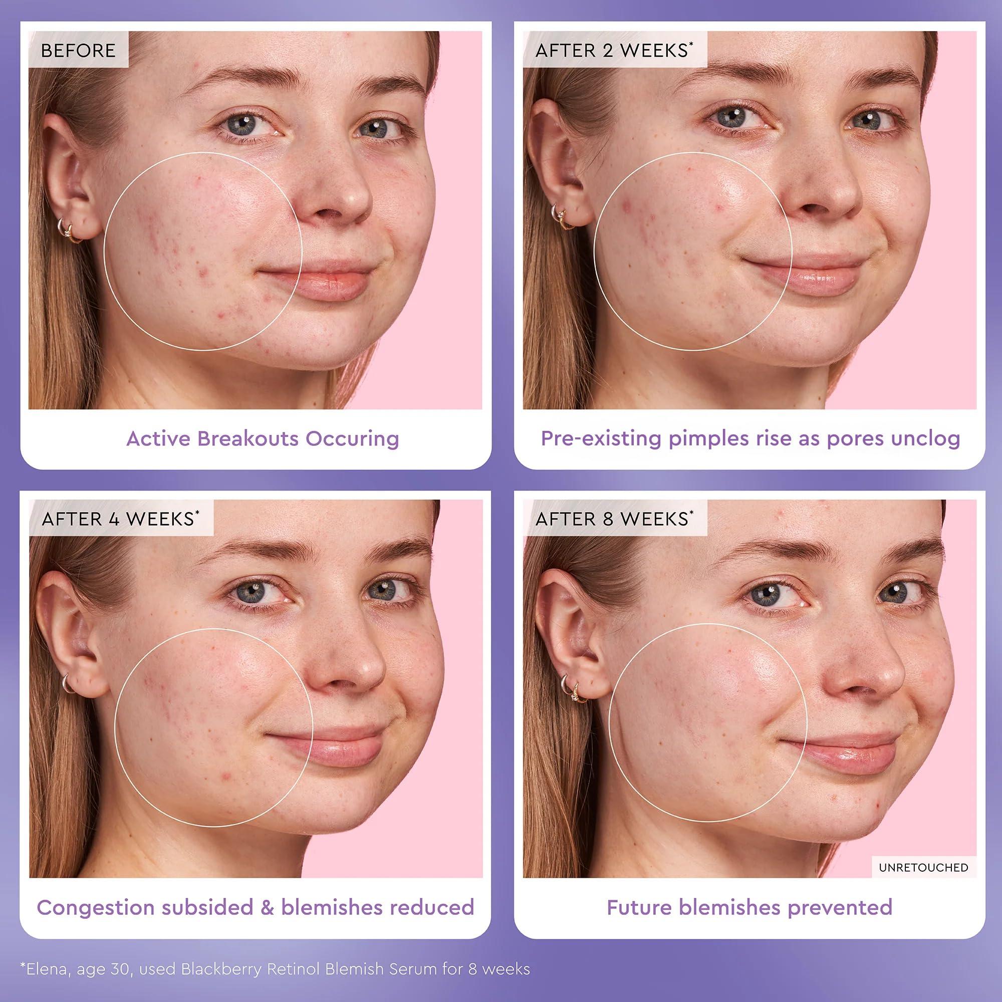 Glow Recipe Glow Recipe Gentle Blackberry Retinol Night Serum - Anti Aging Korean Face Serum for Sensitive Skin + Hydrating Triple Retinoids & Glycerin to Clarify Blemishes, Smooth Texture, Lines & Wrinkles, 30ml