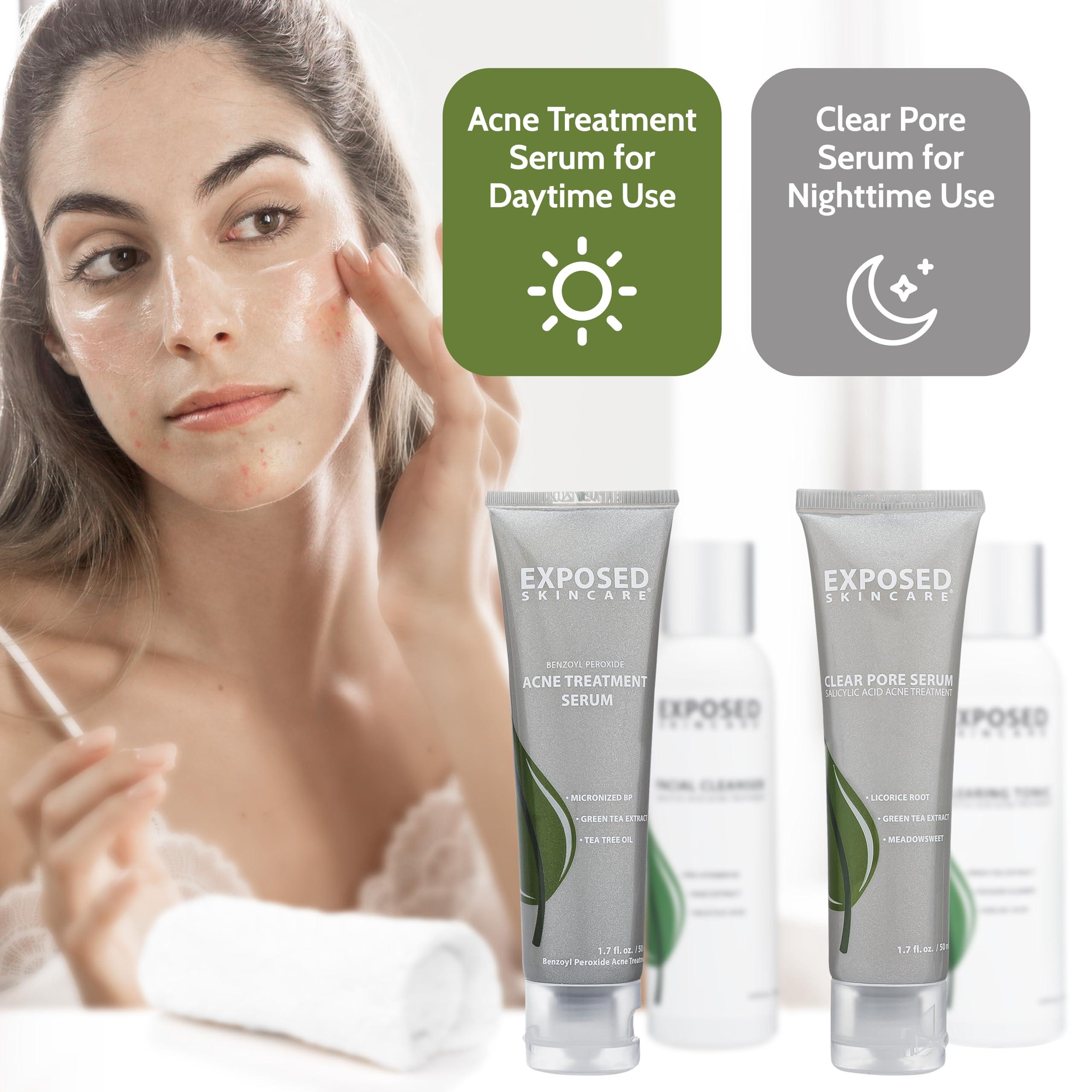 Exposed Skin Care Exposed Skin Care Basic Acne Treatment Kit - Includes Salicylic Acid Face Wash, Clearing Tonic, Acne Treatment Serum with Benzoyl Peroxide, Clear Pore Serum - Acne Set Solution for All Skin Types