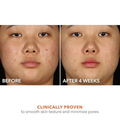 Dr Dennis Gross Dr Dennis Gross Alpha Beta 2% BHA+ Breakout Solution, Minimizes Pores, Clear & Prevent Breakouts, 5 Fl Oz