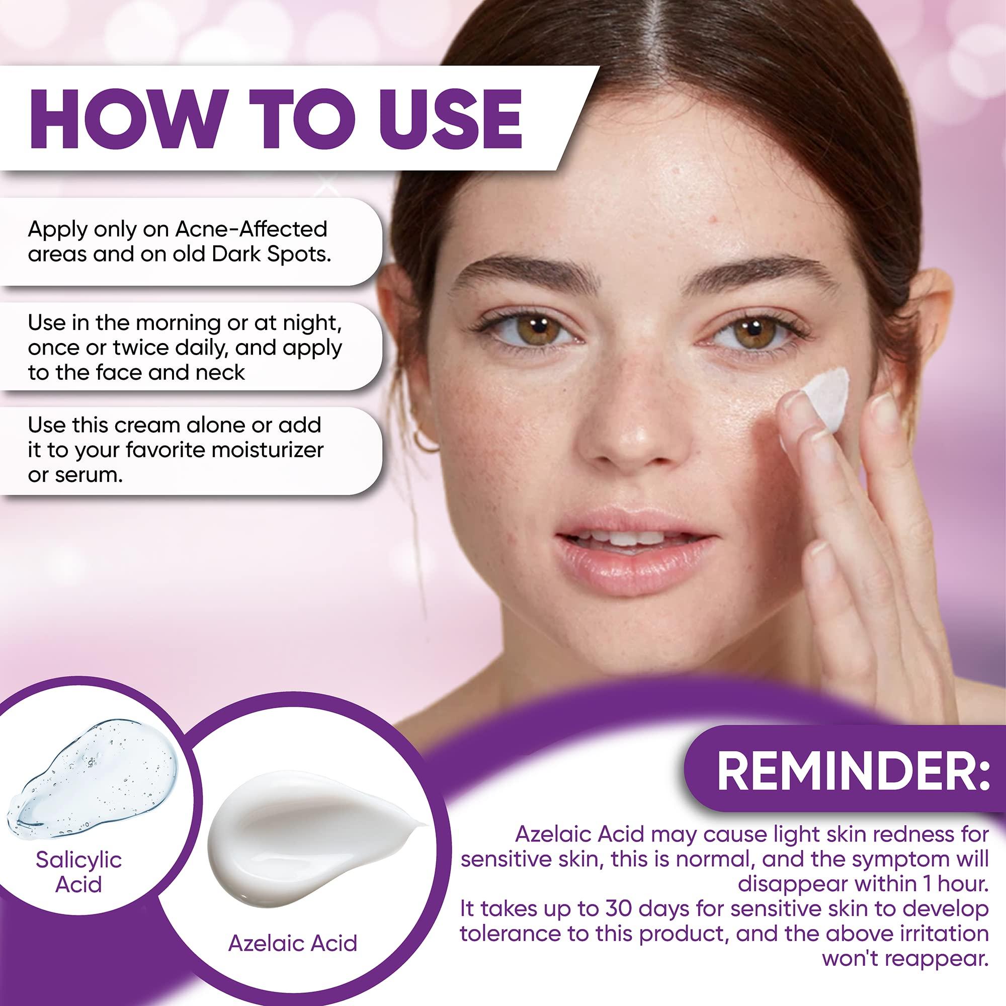 AOBBIY 10% Azelaic Acid Cream: Acne Treatment - Acne Cream - Redness Relief for Face - Redness Reducing Skin Care , Fix Discoloration, Prevent Breakouts, Enhance Skin Tone 1 OZ (2 PACK)