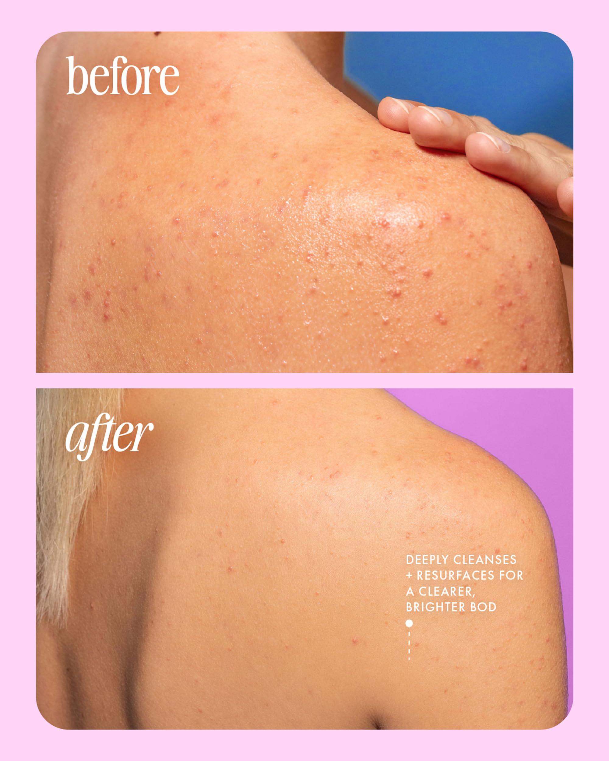 Truly Truly Beauty Cherry Jelly Body Acne Wash with Soothing Cherry Niacinamide, Hydrating Allantoin, & Mandelic Acid - Award Winning Back Acne Treatment Body Wash Cleanser & Dark Spot Remover