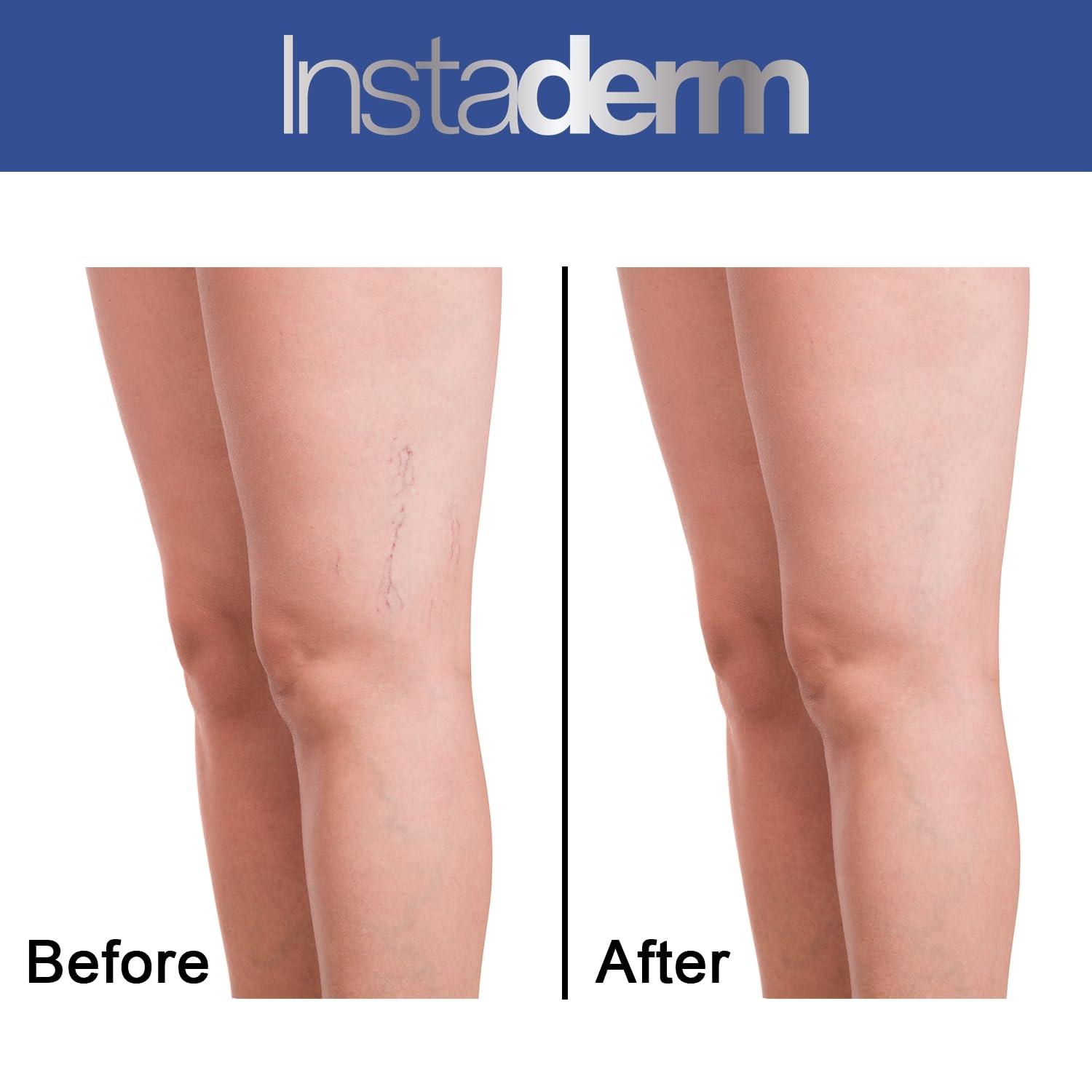 Instaderm Instaderm Vitamin K Cream- Bruise Healing Formula with Arnica. Dark Spot Moisturizer for Bruising, Spider Veins & Broken Capillaries. Repair Under Eye Dark Circles, & Puffiness.
