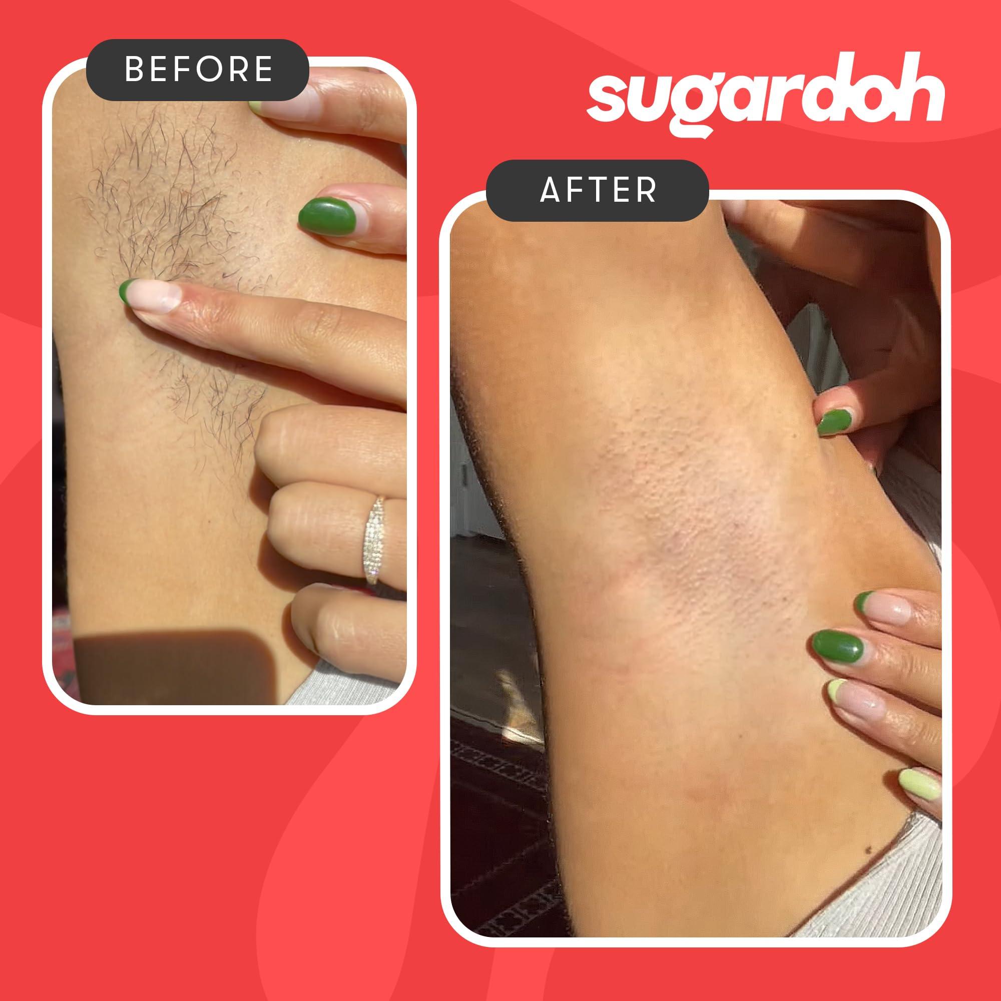 SUGARDOH Sugardoh Sugar Waxing Kit for Women As Seen On Shark Tank (Mini Kit Medium) Face, Arms, & Legs, Sugar Wax Hair Removal- Sugaring Tiktok Viral Products- Bikini Wax Kit for Women - Sugaring Kit