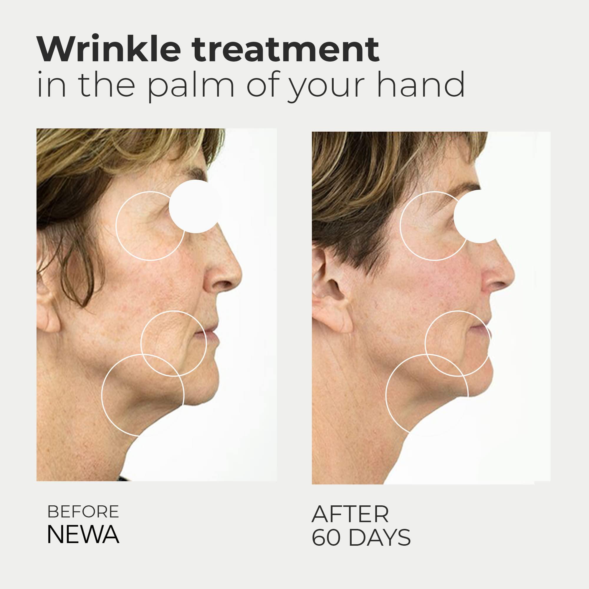 Newa NEWA RF Wrinkle Reduction Device (Wireless) - Skincare Tool for Facial Tightening. Boosts Collagen, Reduces Wrinkles. with 1 Month Gel Supply.