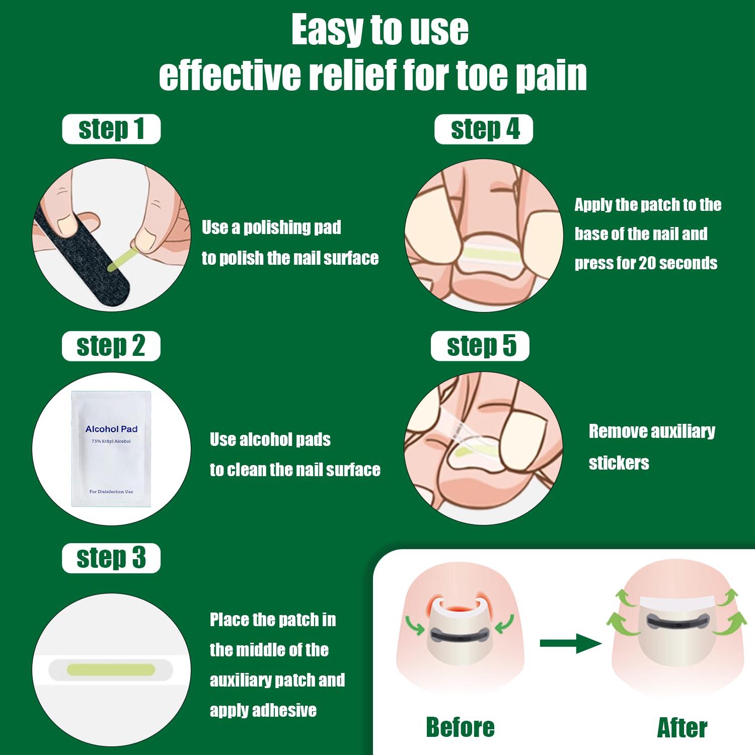 Truine Titanium Ingrown Toenail Corrector,Nail repair tools,Ingrown Toenail Treatment,Suitable for most people with ingrown toenailsIngrown Toenail Removal Kit,- Designed for Ingrown Toenail Repair10pcs