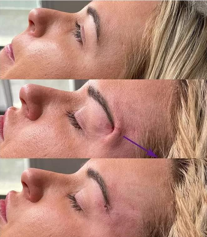 MatYas 20Pcs Pdo Cog Threads 4D 21G60mm for Fox Eye Lifting, W-Type, Barb Cog Threads