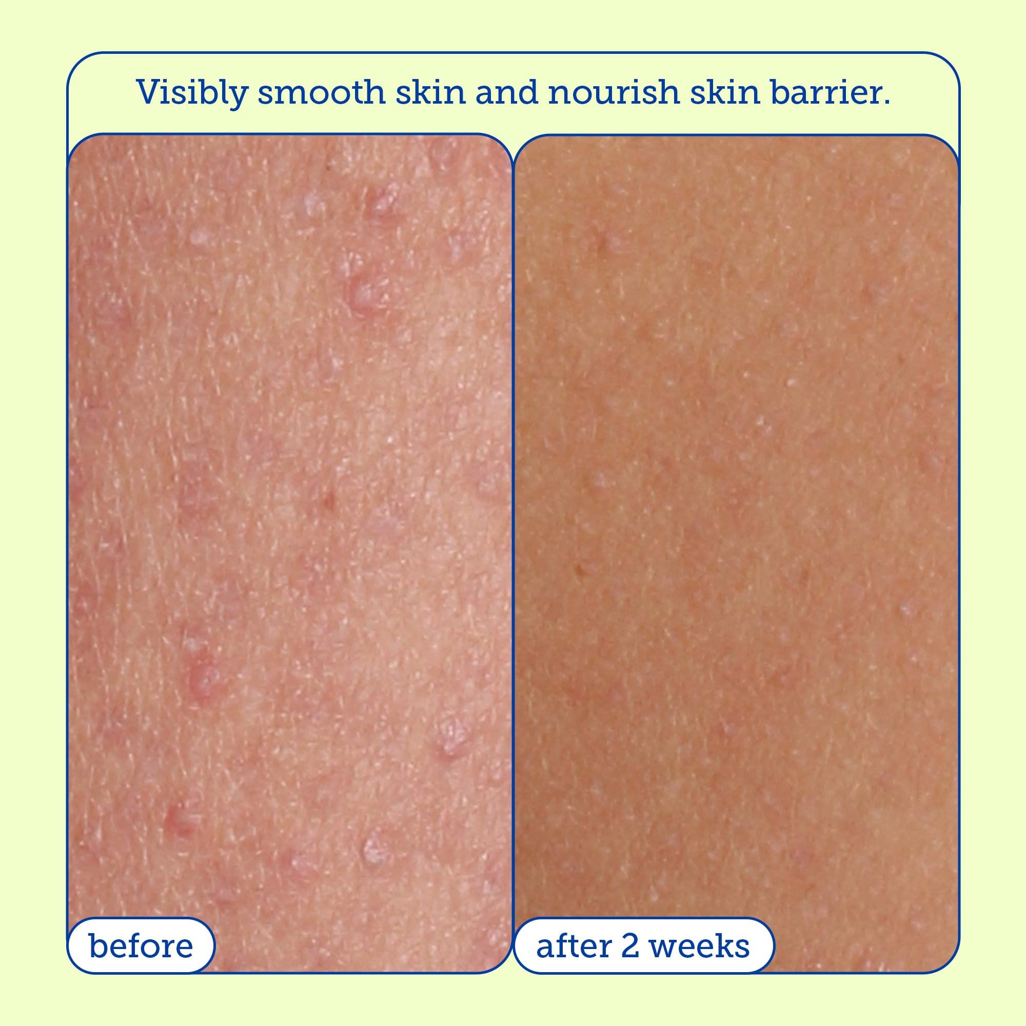 Skinfix Skinfix Resurface+ AHA/BHA Renewing Cream: Exfoliating Body Cream That Visibly Smooths Rough, Bumpy & Crepey Skin While Moisturizing With Shea Butter, Jojoba Oil & Glycerin, 10 Fl Oz