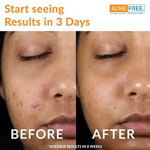 AcneFree AcneFree 24 Hour Acne Clearing System 1 kit (Pack of 2)