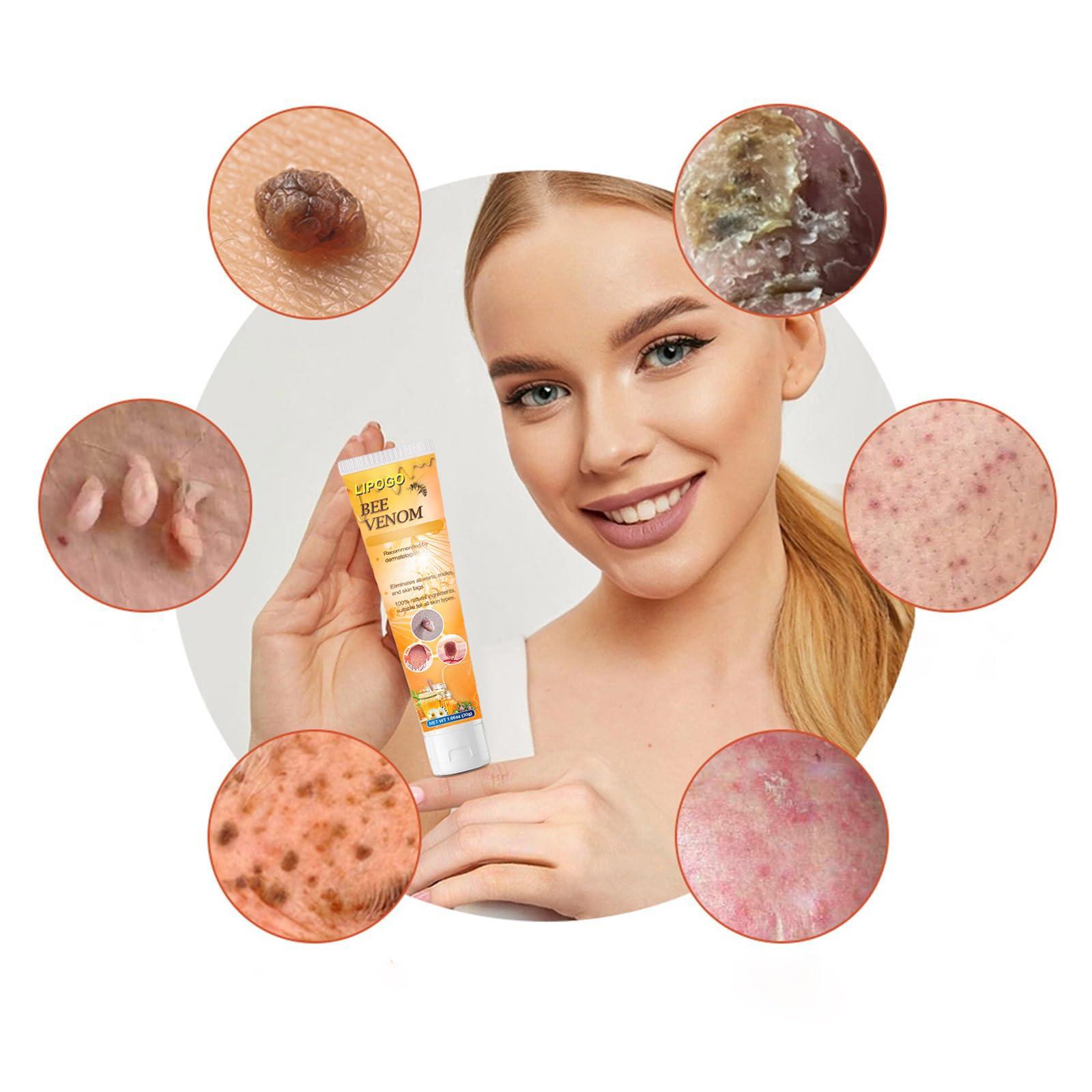 flysmus flysmus LIPOGO Bee Venom Treatment Cream - Professional Bee Venom Repair Cream, Bee Venom Treatment Gel for All Skin Types (4PCS)