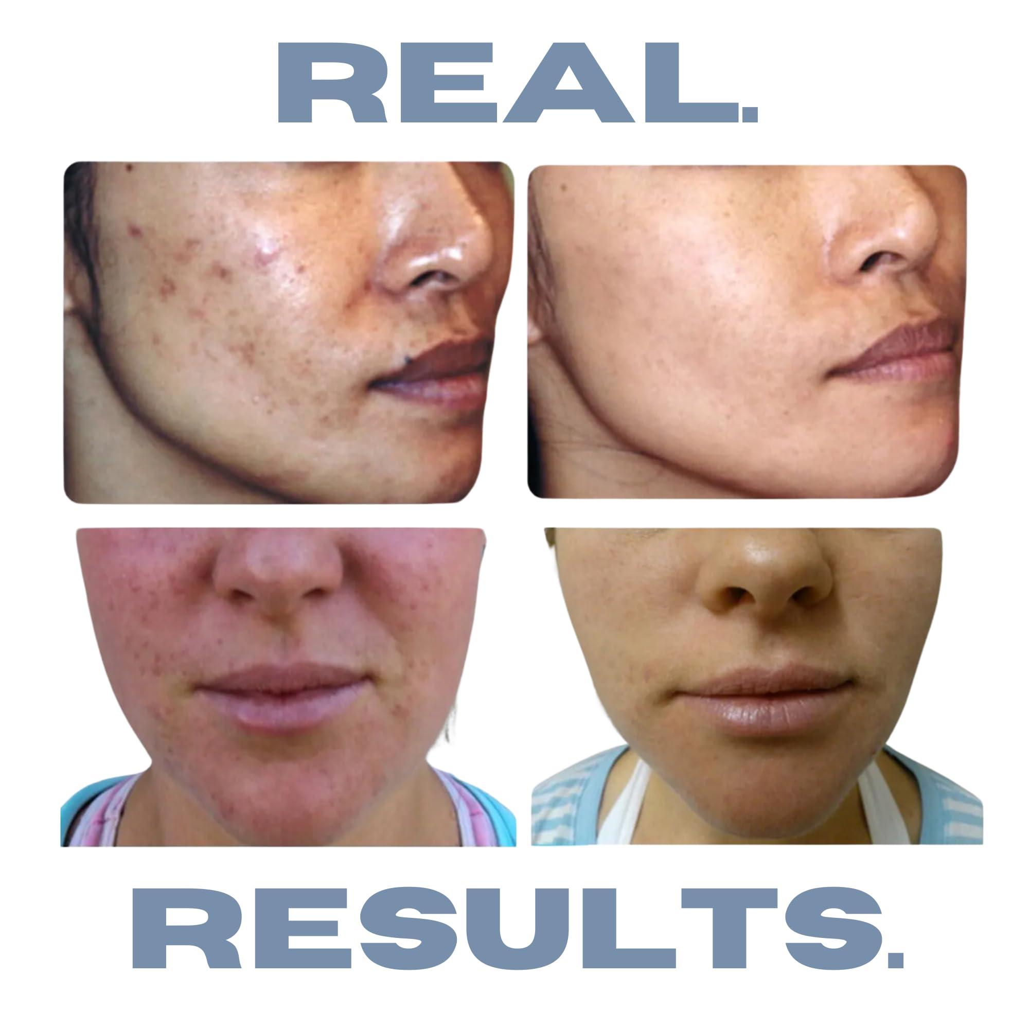 Clearogen Clearogen Hormonal Acne Solution Natural Anti-DHT Deluxe Set, 2-Month Sensitive Skin Kit