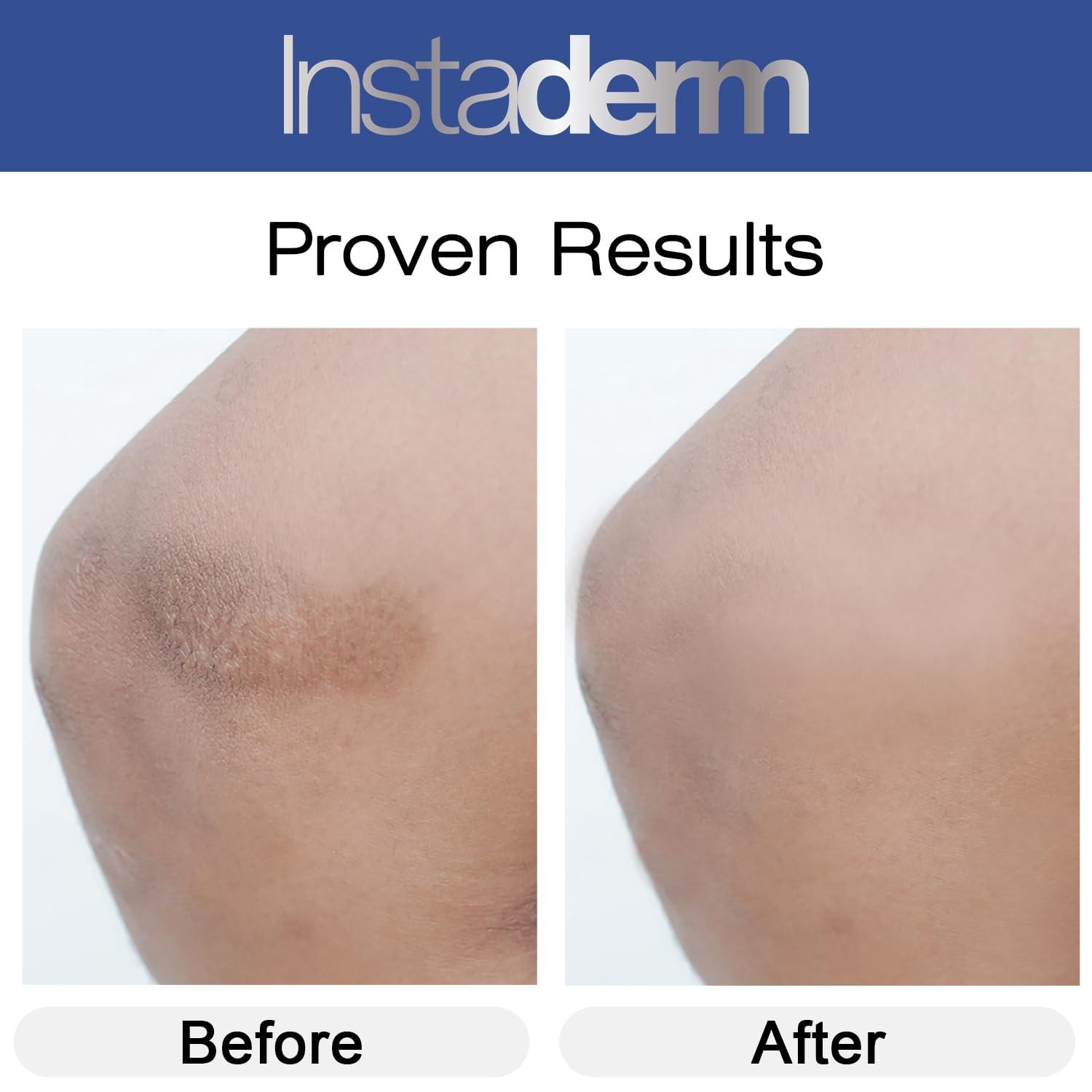 Instaderm Instaderm Vitamin K Cream- Bruise Healing Formula with Arnica. Dark Spot Moisturizer for Bruising, Spider Veins & Broken Capillaries. Repair Under Eye Dark Circles, & Puffiness.