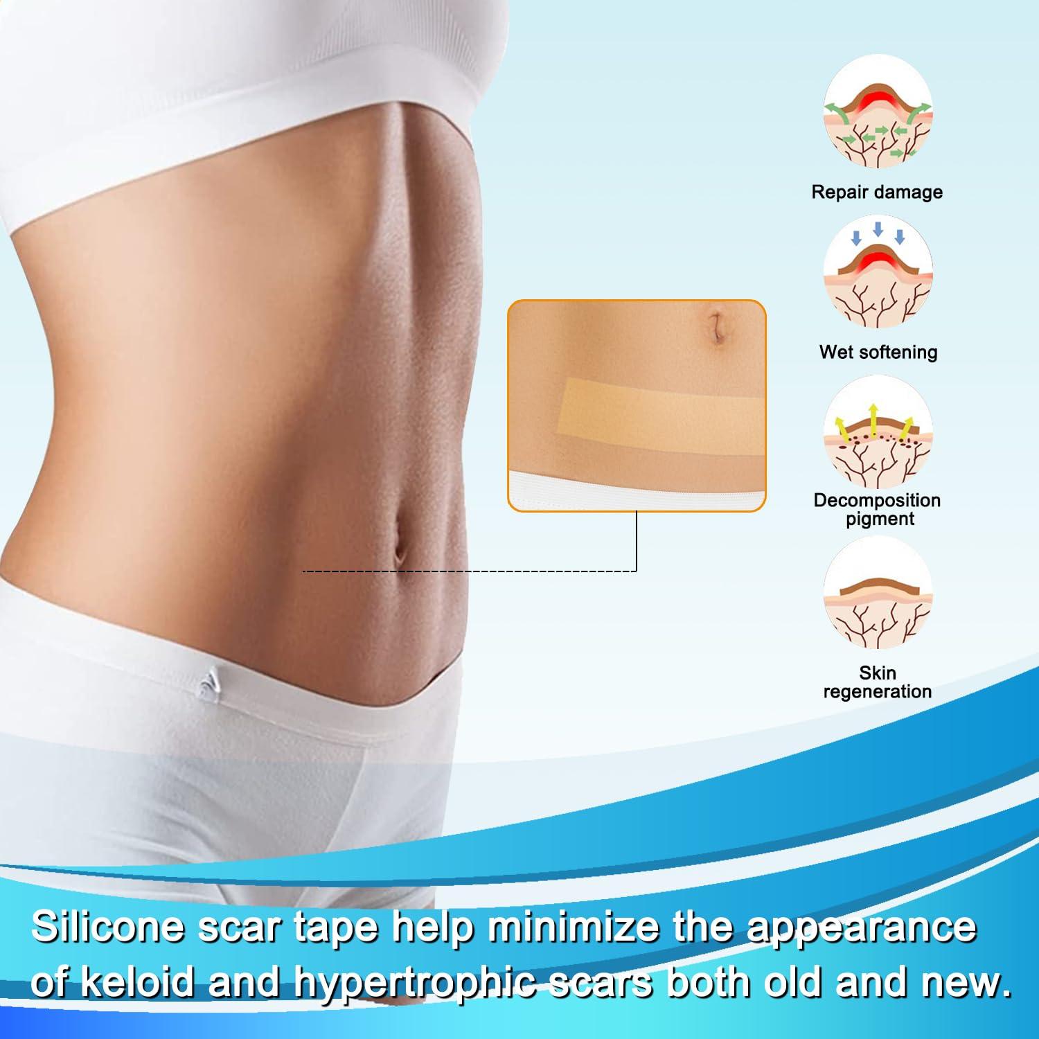 Hysimedy Medical Grade Silicone Scar Tape for Surgical Scars (1.6\" x 120\" - 3M) Professional Silicone Scar Sheets Scar Treatment for Face Wrinkles, C Section Recovery, Keloid Bump Removal Silicone Scar Patches