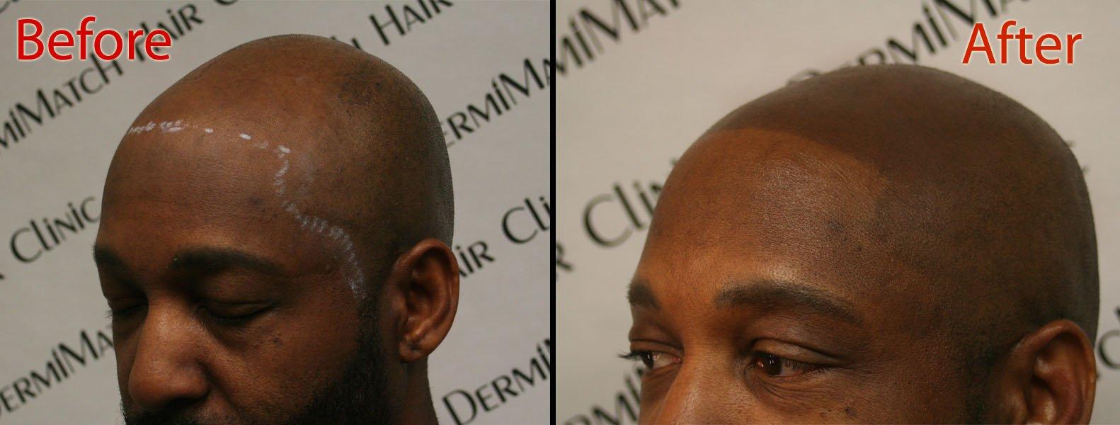 DermiMatch LLC B - Scalp micropigmentation pigments by DermMicro (B)