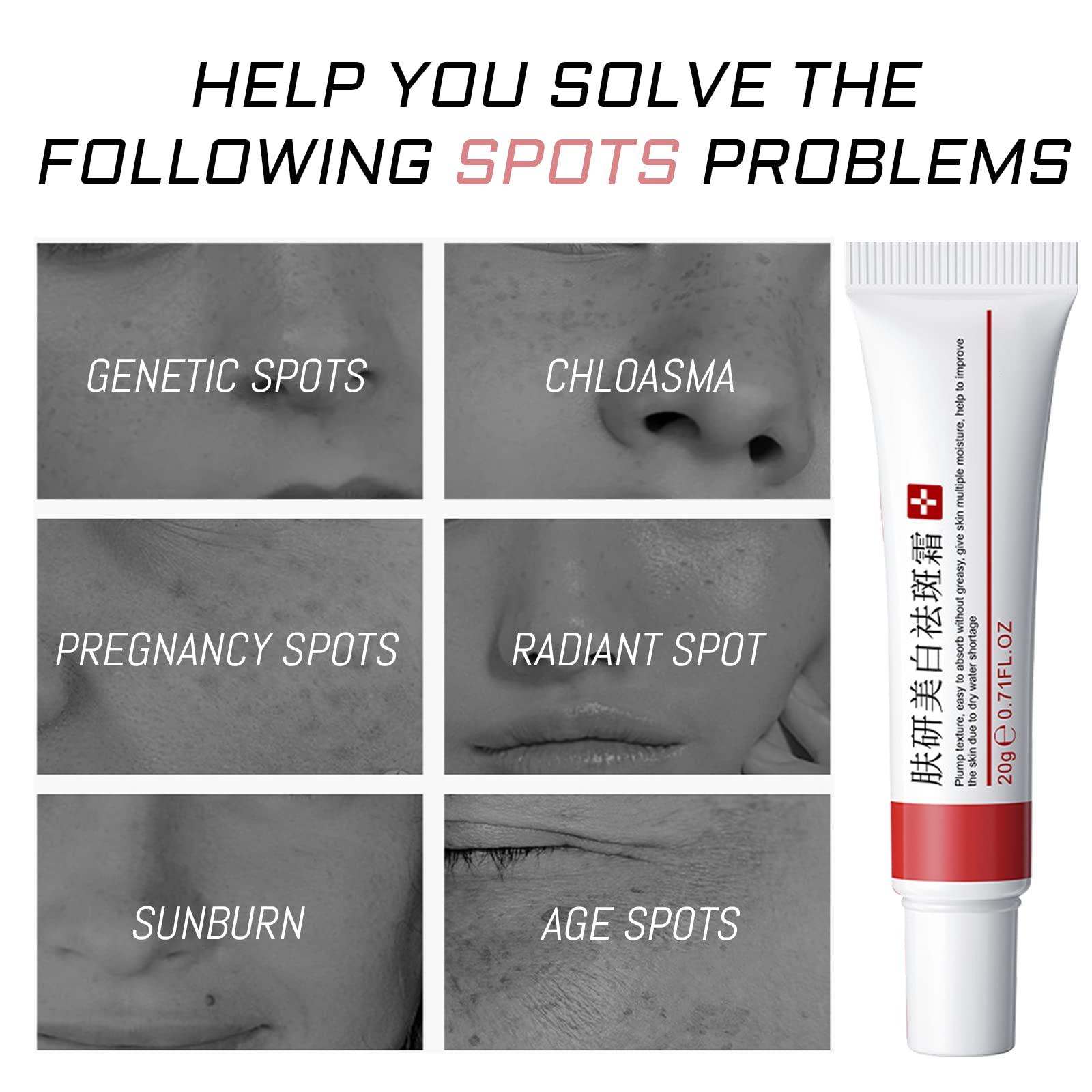 fupah 2 Pcs Freckle Cream, Acne Scar Removal Treatment Cream, Pigmentation Removal Cream for Face, Moisturizing Removes Facial Melasma Dark Spots Wrinkles Blemishes (freckle cream)