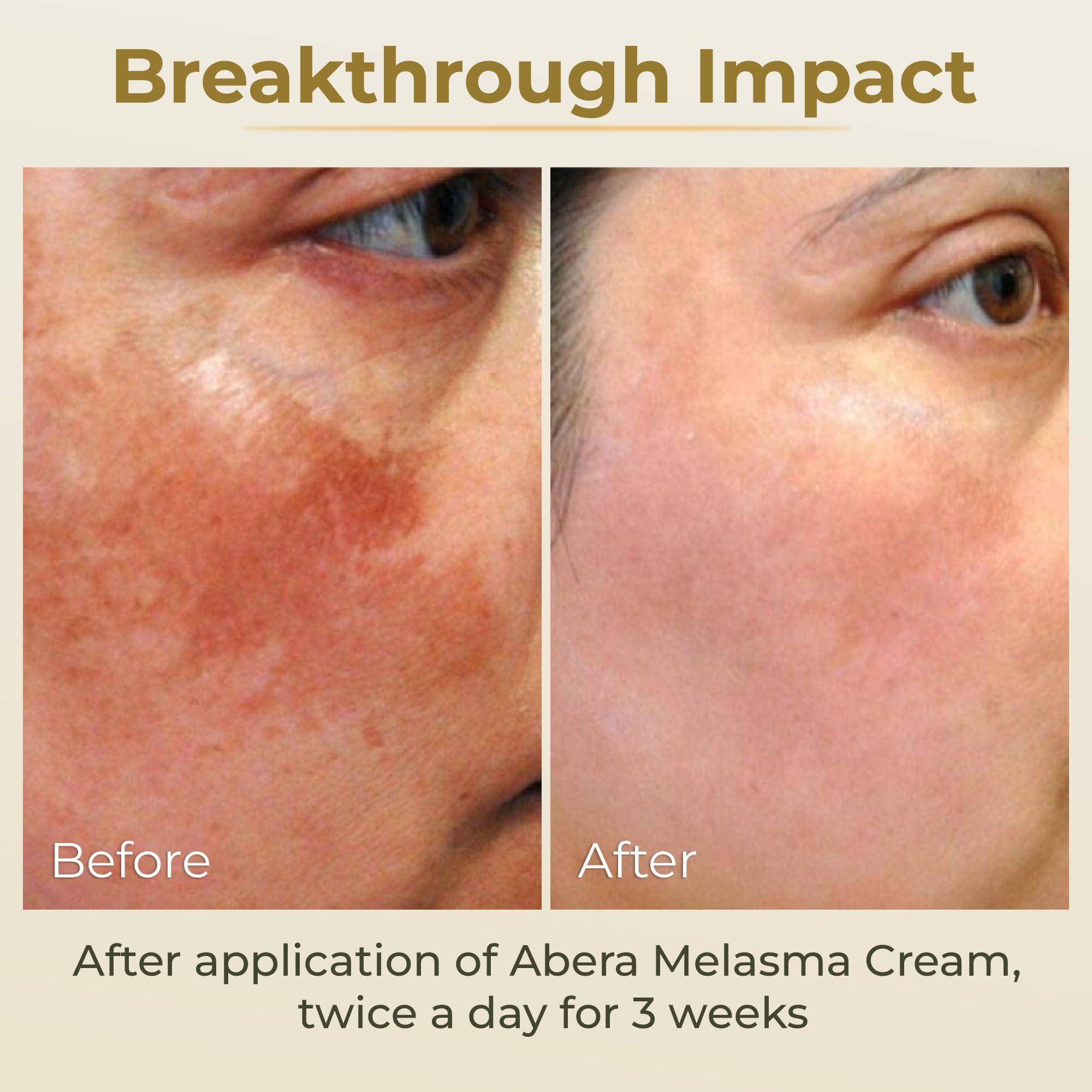 ABERA ABERA Dark Spot Remover for Face: Dark Spot Corrector for Age Spot Sun Spot Freckles Melasma Brown Spot - Faded Spot Correcting Cream for Face Hands (3 Boxes)