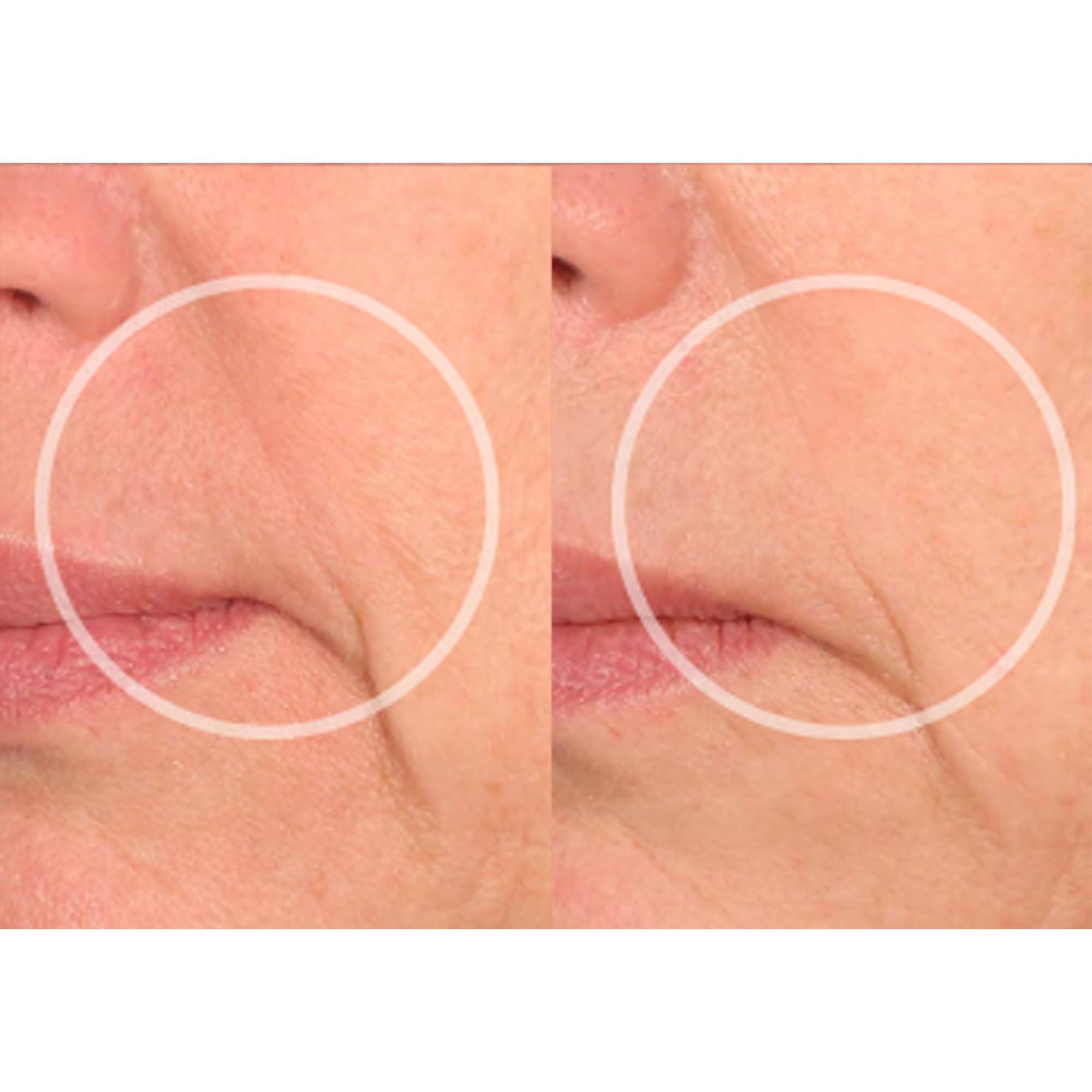 SiO SiO Beauty Eye & Smile Lift | Eye & Smile Anti-Wrinkle Patches 2 Week Supply | Overnight Smoothing Silicone Patches for Wrinkles and Fine Lines