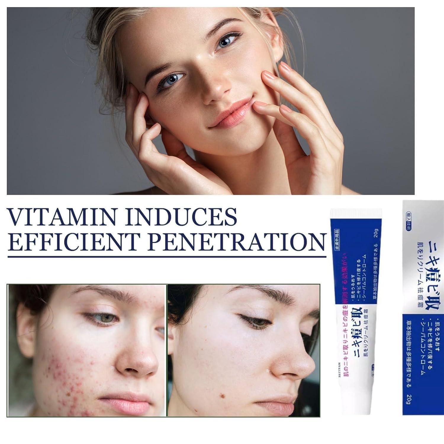 getuse Lion Pair Acne Cream, 20g | Natural Acne Gel for Face | Japanese Moisturizing Treatment for Women & Men | 3pcs (1pc)