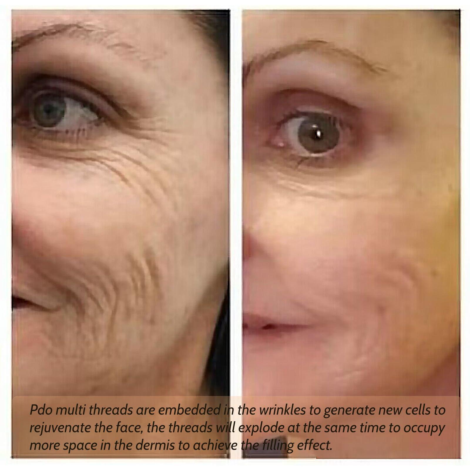 Oldream Oldream Pdo Multi Threads for Face Lift, L-Type, 23G38MM, 20pcs