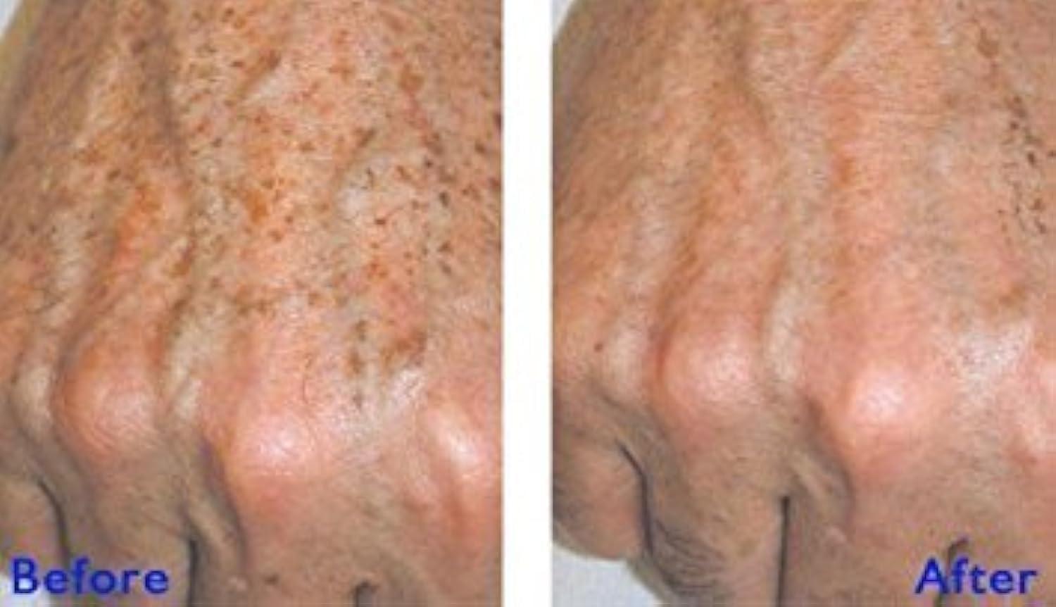 True Radiance JESSNER\'S (JESSNER Peel) by True Radiance Chemical Peel. Exfoliating, Skin resurface, Collagen Production, Remove hyperpigmentation, pimples and Age or Liver Spots. 1 oz/30ml.