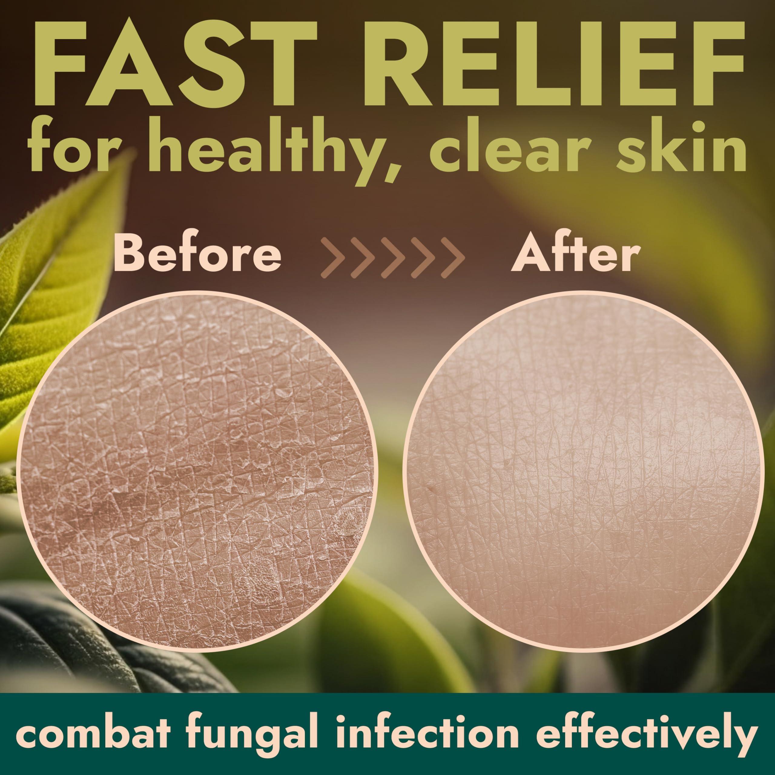 Terramed Just Think Comfort Antifungal Body Wash with Tea Tree Oil | Antibacterial Soap for Back Acne,Treats Ringworm, Eczema & Jock Itch | Antibacterial Body Soap For Men And Women | Includes Silicon Body Scrubber (16.9 oz)