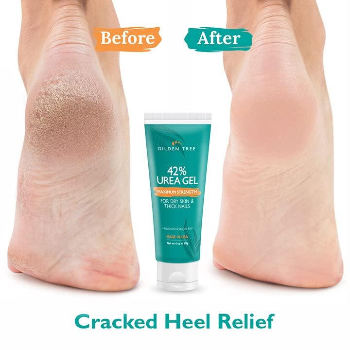 GILDEN TREE GILDEN TREE Urea Gel 42 Percent For Feet Maximum Strength Softens Cracked Heel Calluses & Thick Toenails
