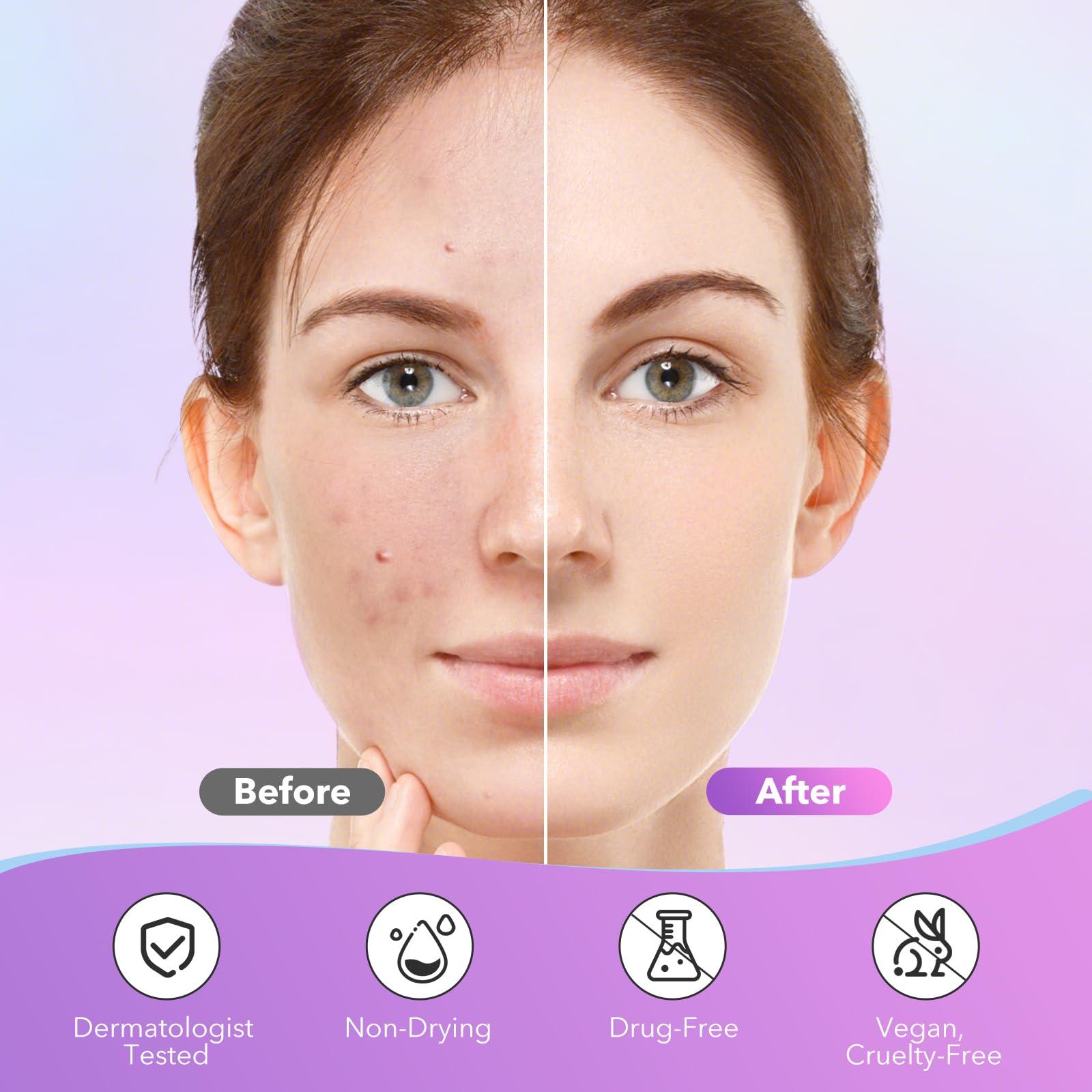 QUSTERE QUSTERE Pimple Patches for Face, Hydrocolloid Acne Patches, Cute Star Zit Covers for Face, Colorful Spot Stickers with Tea Tree, Salicylic Acid & Cica Oil| 3 Sizes (10mm, 12mm & 14mm) |280 Count