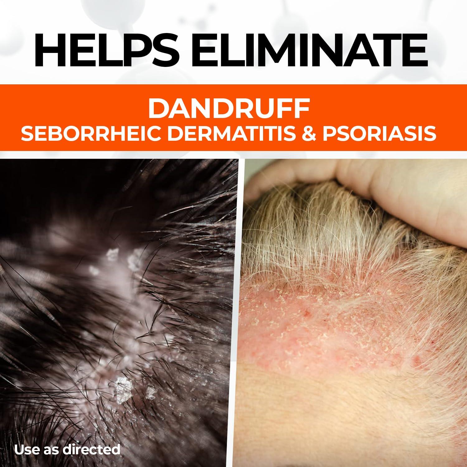 Medicasp Medicasp Coal Tar Gel Dandruff Shampoo to Treat Seborrheic Dermatitis Psoriasis, 6 Ounce (Pack of 1)