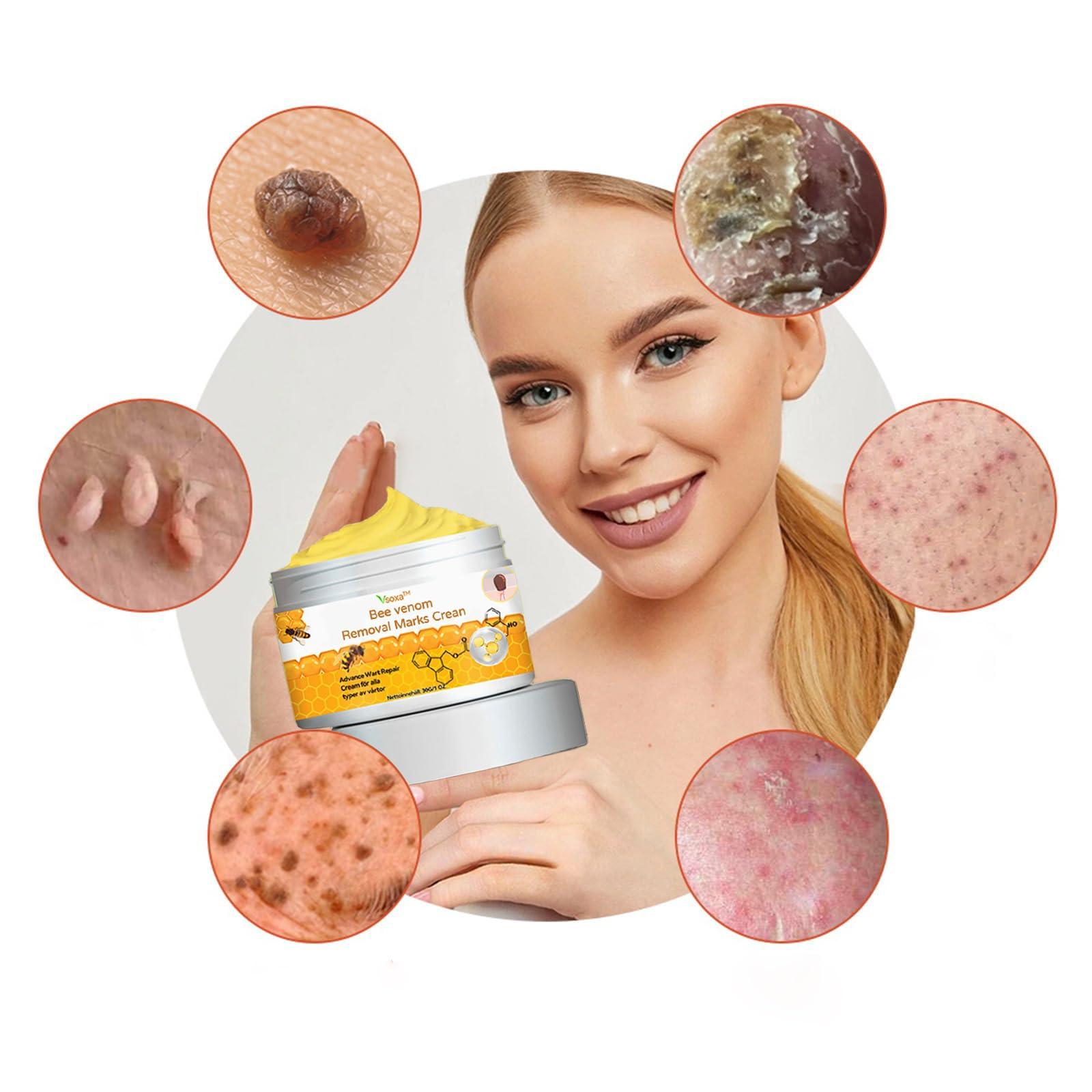 flysmus flysmus Bee venom Removal Marks Cream, Bee Venom Repair Cream, Bee Venom Removal Cream - All Skin Types (4PCS)