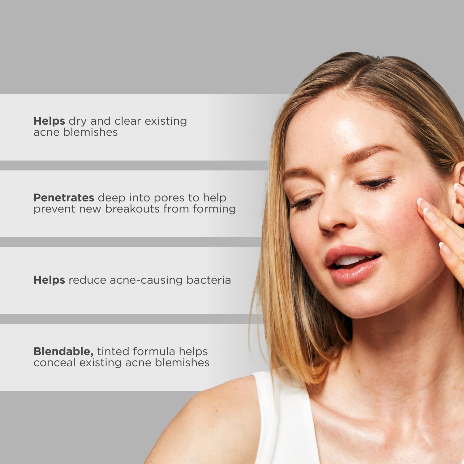 GLYTONE Glytone Acne Spot Treatment Face Cream with 8% Sulfur & 2% Resorcinol, Tinted Acne Treatment for Teenagers, Conceals Blemishes, 1 oz