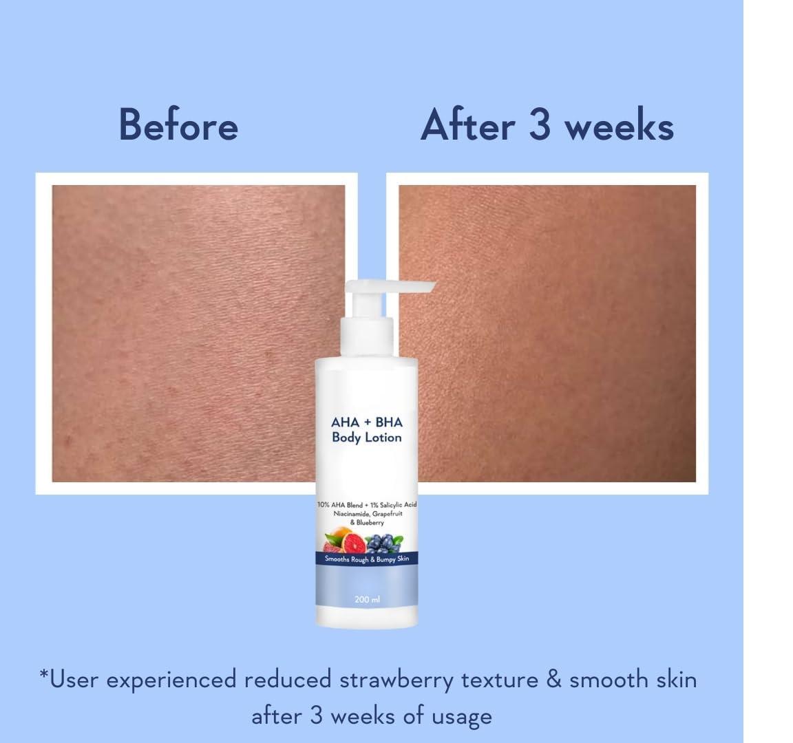 Generic JAY 10% AHA + 1% BHA Body Lotion - Smooths Rough & Bumpy Skin - Glycolic & Lactic Acid Body Lotion with Niacinamide - 200 Ml