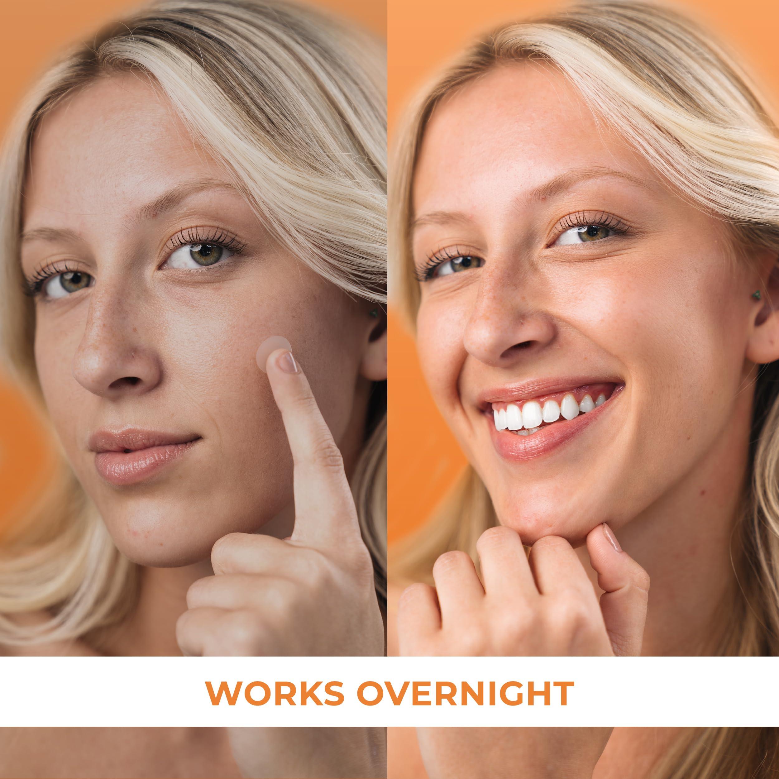 KEYCONCEPTS PatchRx Pimple Patches for Face (240 Patches), Hydrocolloid Acne Patches, Pimple Patch Pimple Stickers, Hydrocolloid Patch Acne Dots Acne Pimple Patches For Face, Zit Patches, Acne Spot Treatment