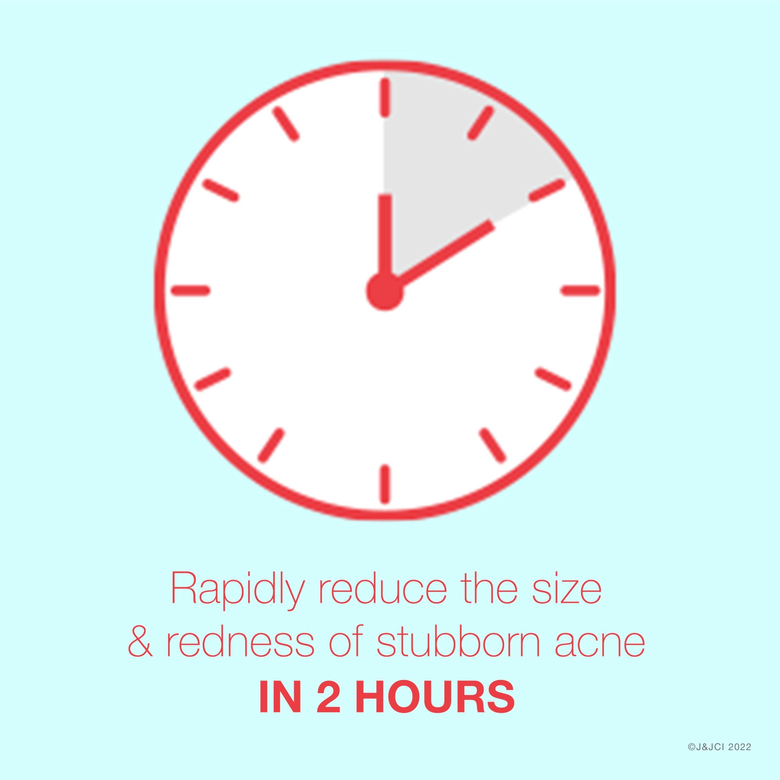 Neutrogena Neutrogena Rapid Clear Stubborn Acne Spot Treatment Gel with Maximum Strength 10% Benzoyl Peroxide Acne Treatment Medication, Pimple Cream for Acne Prone Skin Care, 1 oz