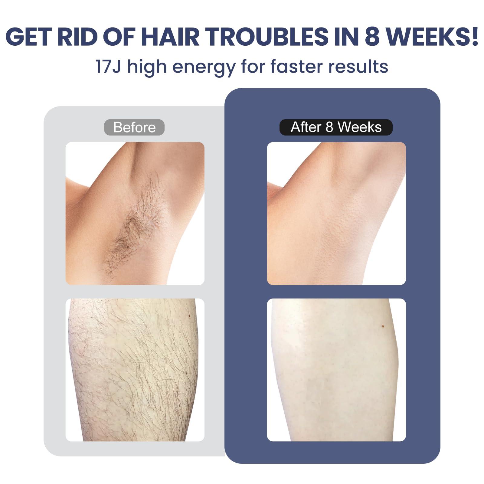 ViQure Viqure IPL T8 Laser Hair Removal for Women and Men, Fast and Long-lasting Painless Hair Removal Device with Cooling System, 990000 Flash, LED, Multifunction Double Head, For Body & Face at-Home Use