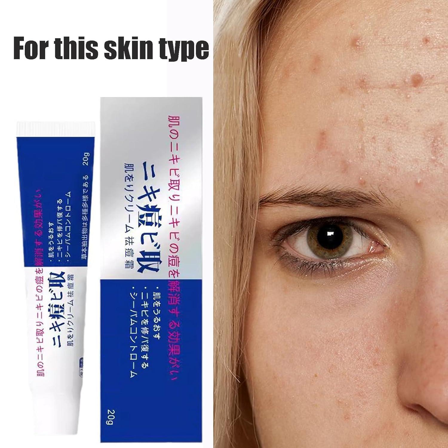 getuse Lion Pair Acne Cream, 20g | Natural Acne Gel for Face | Japanese Moisturizing Treatment for Women & Men | 3pcs (1pc)